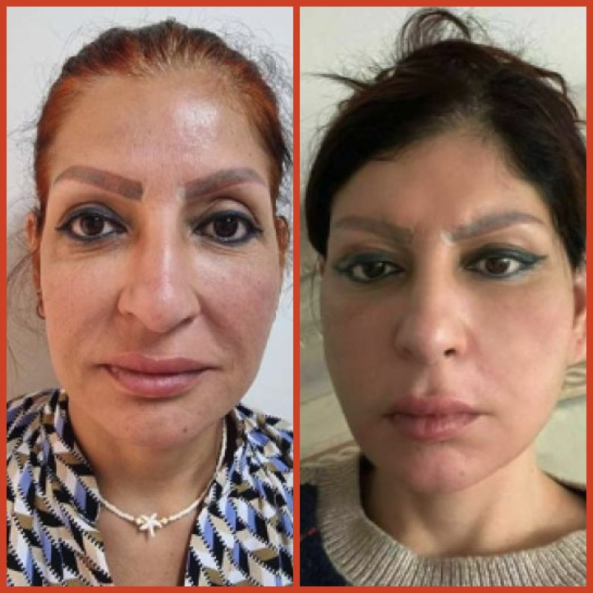Resultados de lifting facial antes y después en DGB Clinic, rejuvenecimiento visible