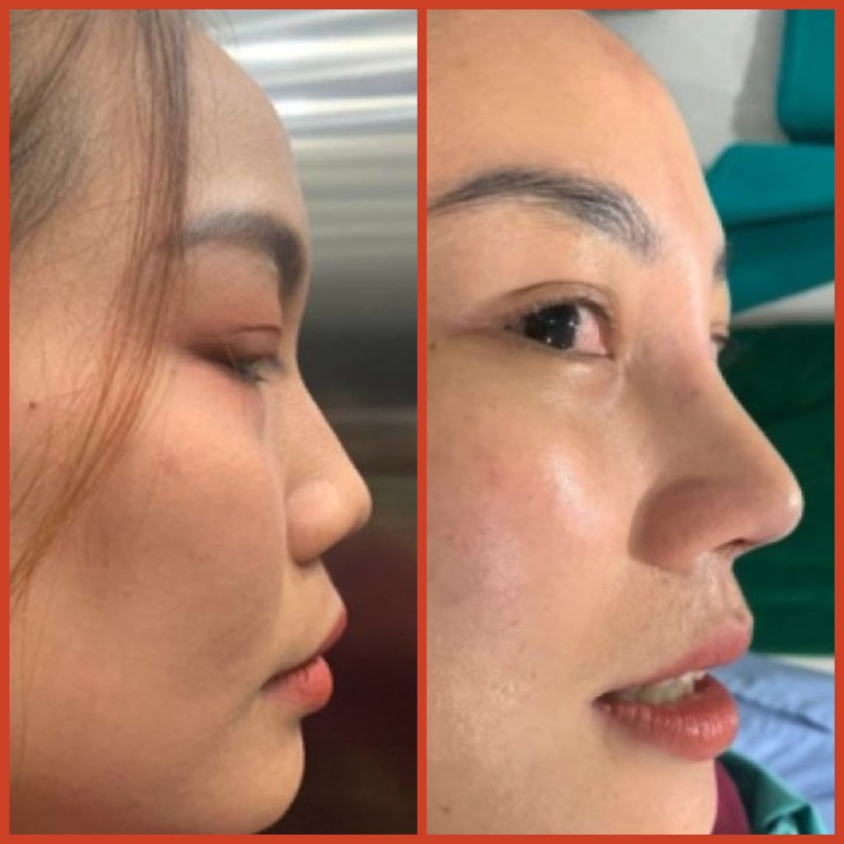 Resultados de rinoplastia antes y después en DGB Clinic, perfil y contorno nasal mejorados