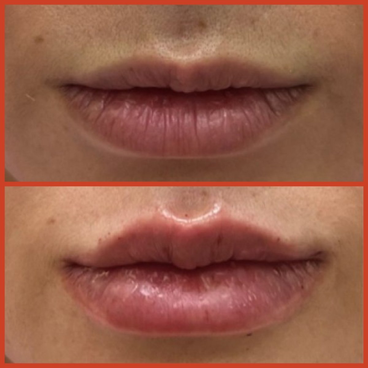 Résultat avant/après injection de fillers lèvres à DGB Clinic – volume et forme améliorés