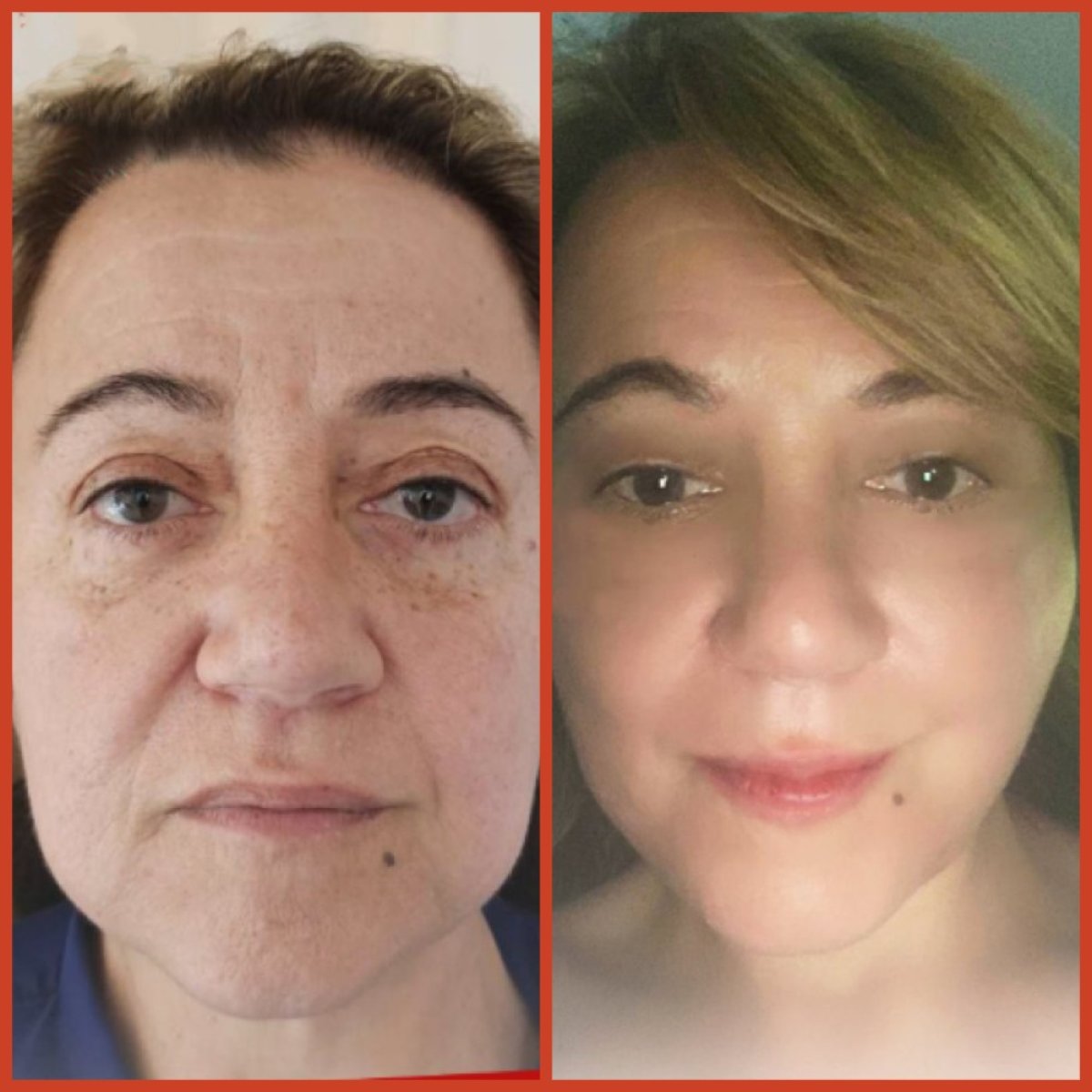Resultados de lifting facial antes y después en DGB Clinic – rejuvenecimiento visible