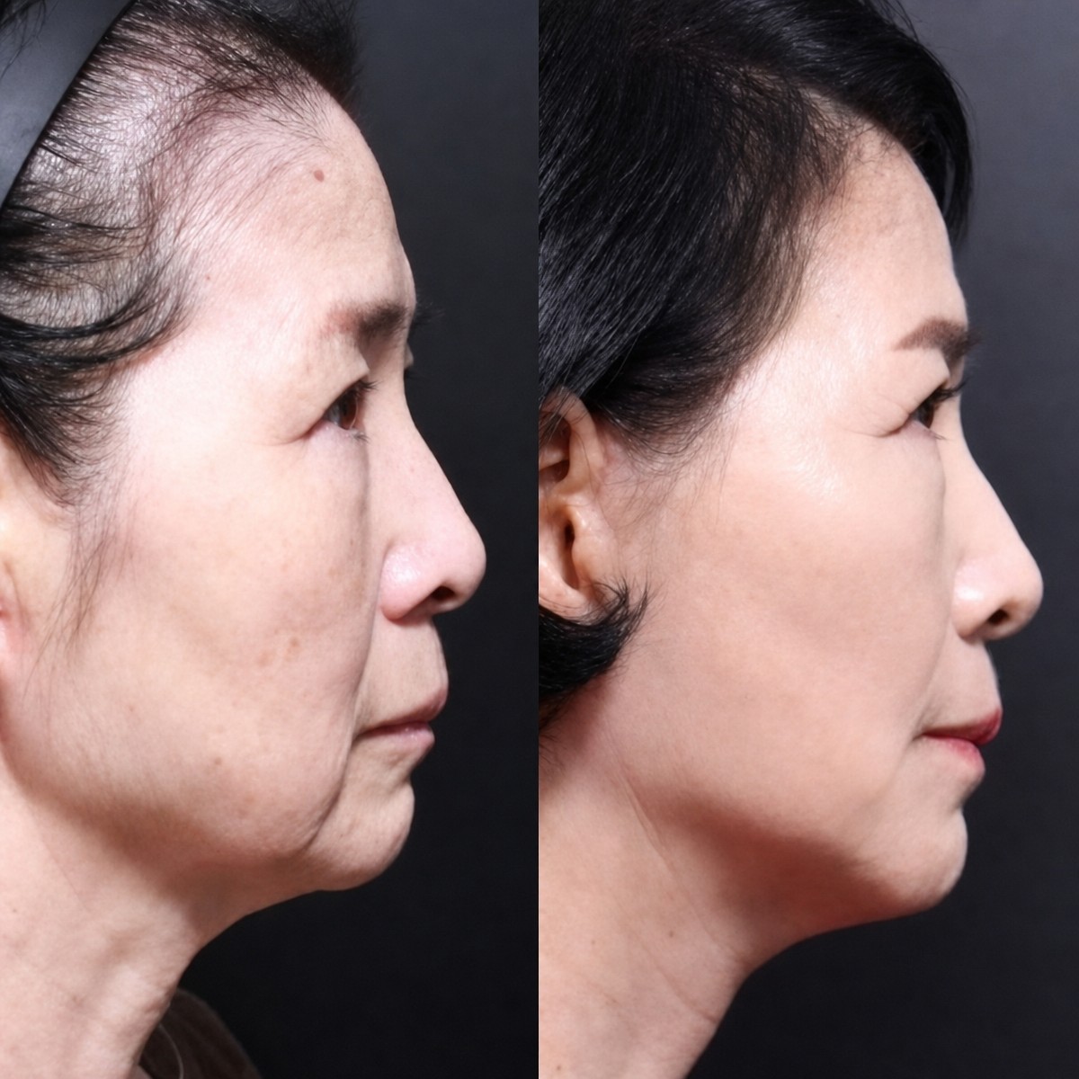Resultados de lifting de cuello antes y después en Returning Plastic Surgery, mandíbula más definida