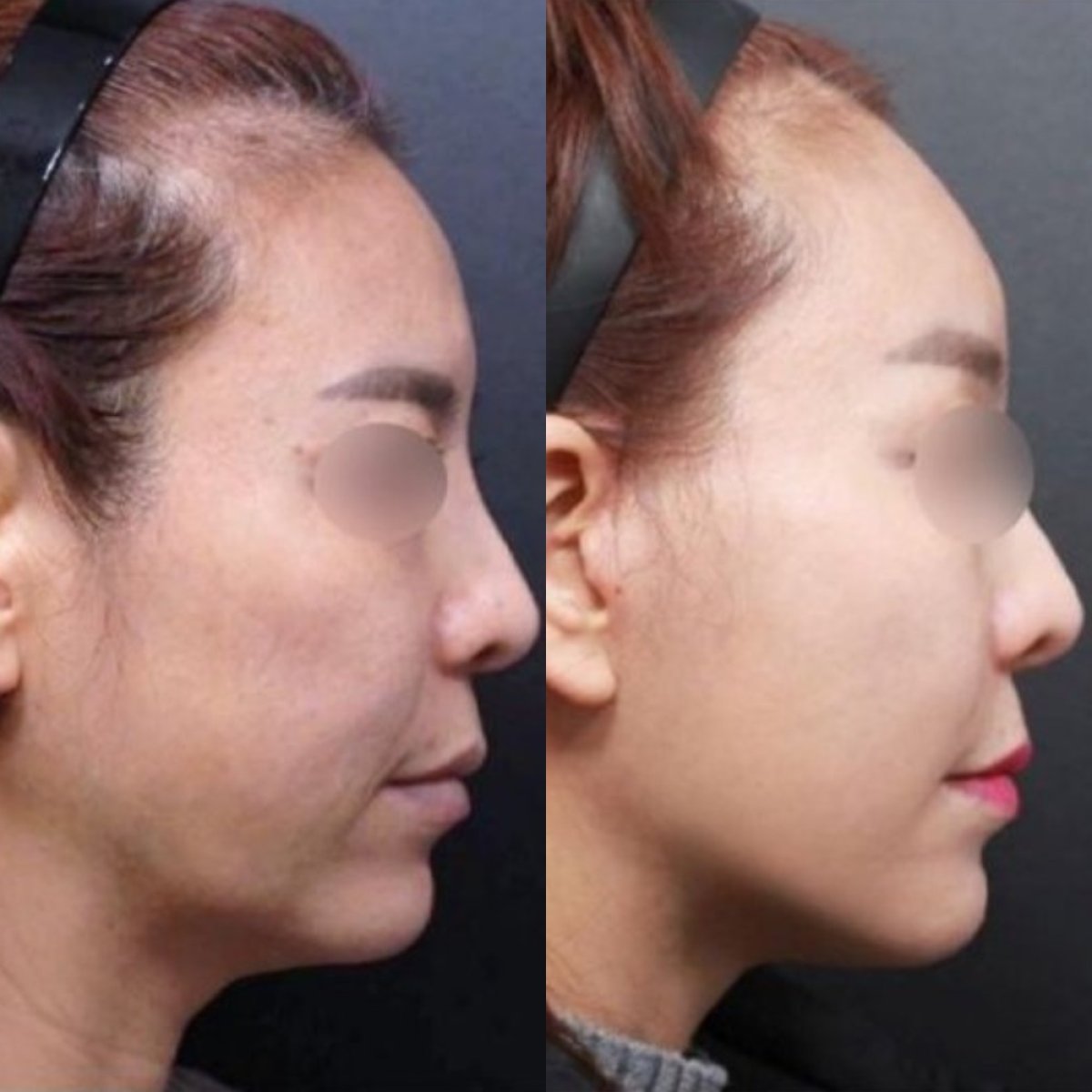 Resultados de lifting de cuello antes y después en Returning Plastic Surgery, mejora de la mandíbula