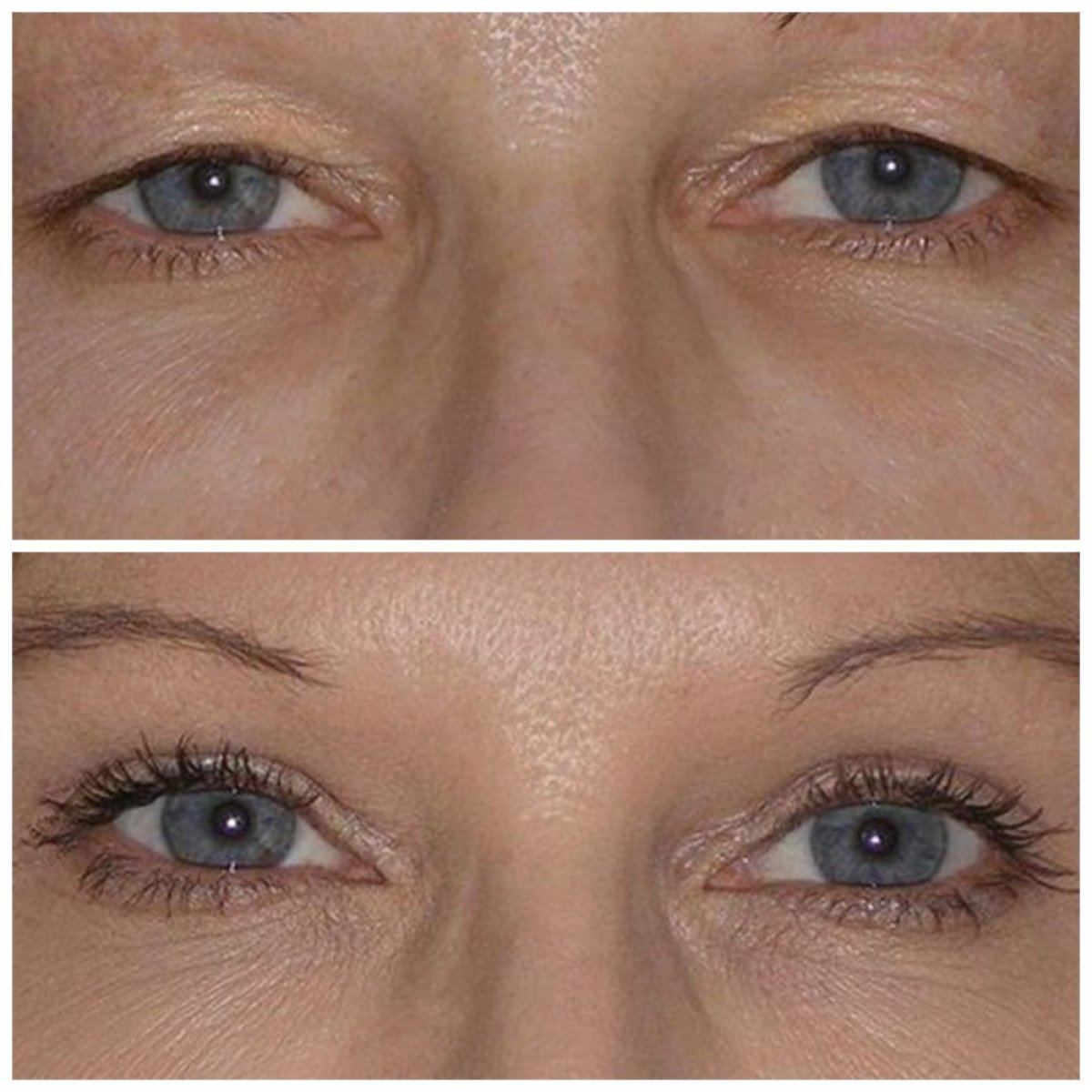 Before and after lower eyelid blepharoplasty results at TWT Health Clinic, eye rejuvenation