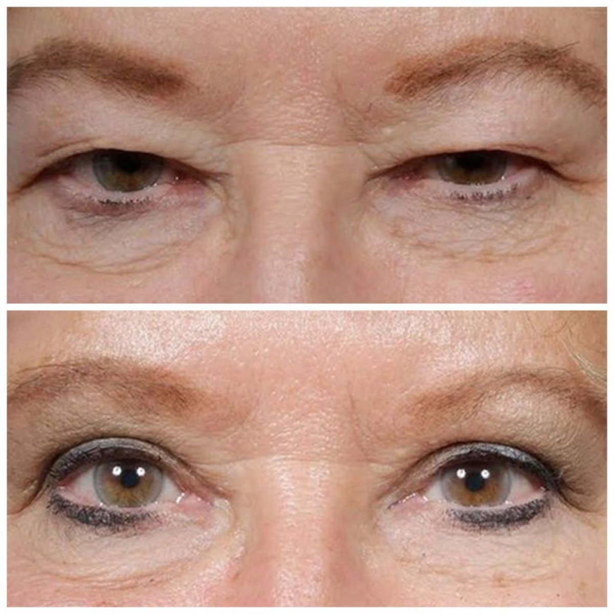 Resultados de blefaroplastia inferior antes y después en TWT Health Clinic, ojos rejuvenecidos