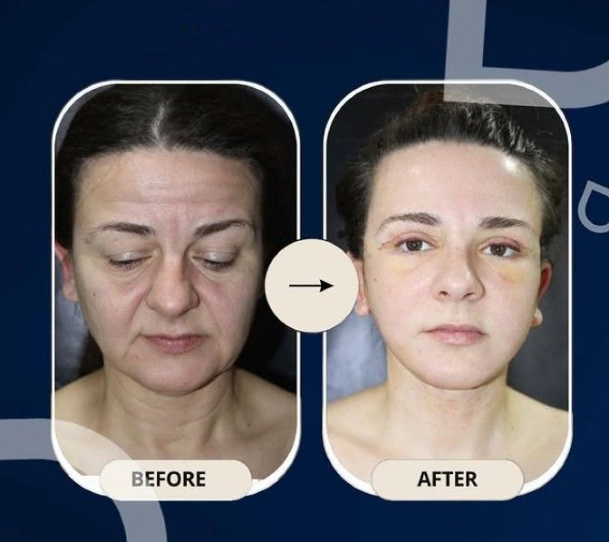 Resultados de blefaroplastia de párpado inferior antes y después en TWT Health Clinic