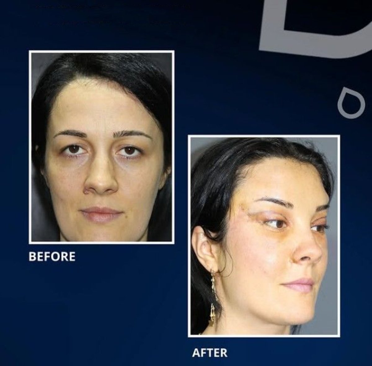 Resultados de blefaroplastia de párpado inferior antes y después en TWT Health Clinic