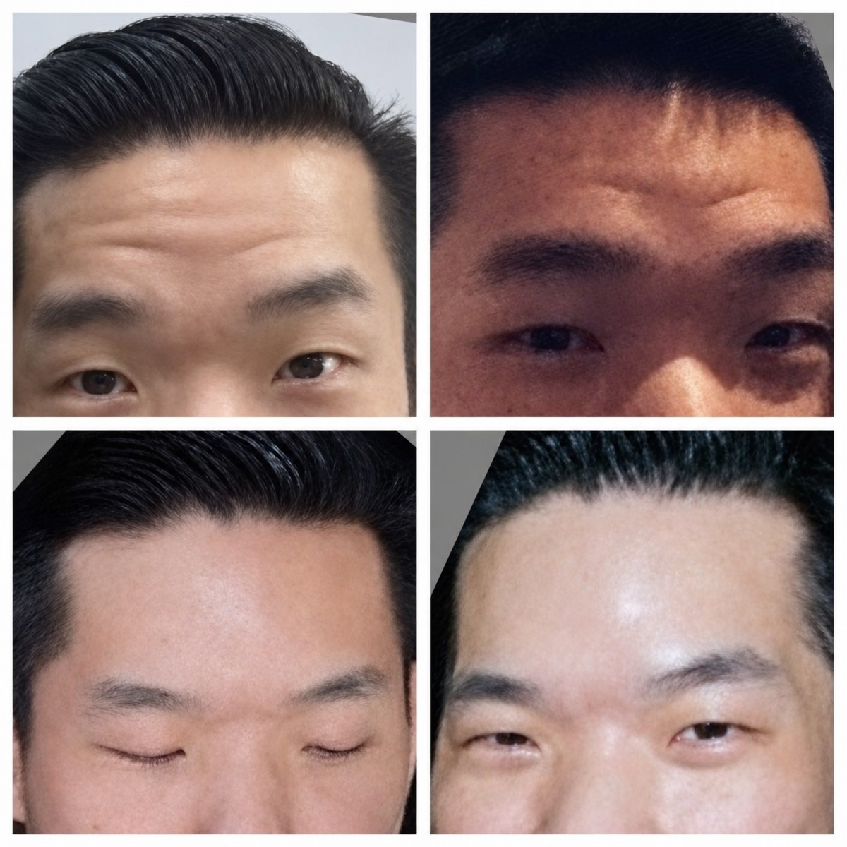 Before and after facial fat transfer results at Asia Cosmetic Hospital, smoother forehead appearance