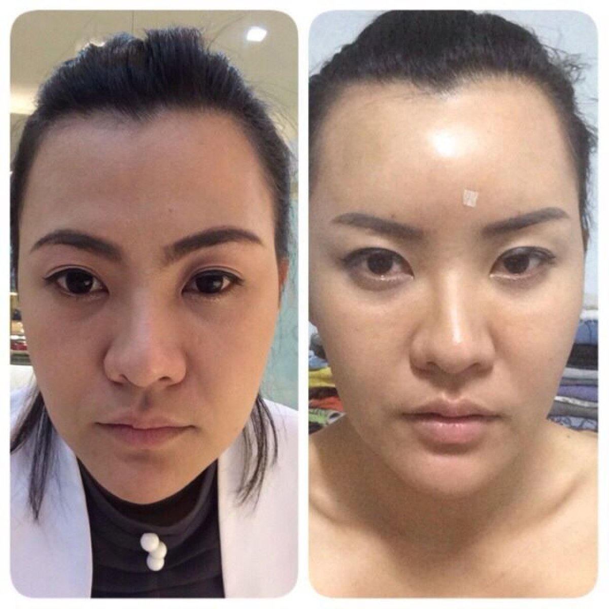 Before and after facial fat transfer results at Asia Cosmetic Hospital, enhanced facial volume