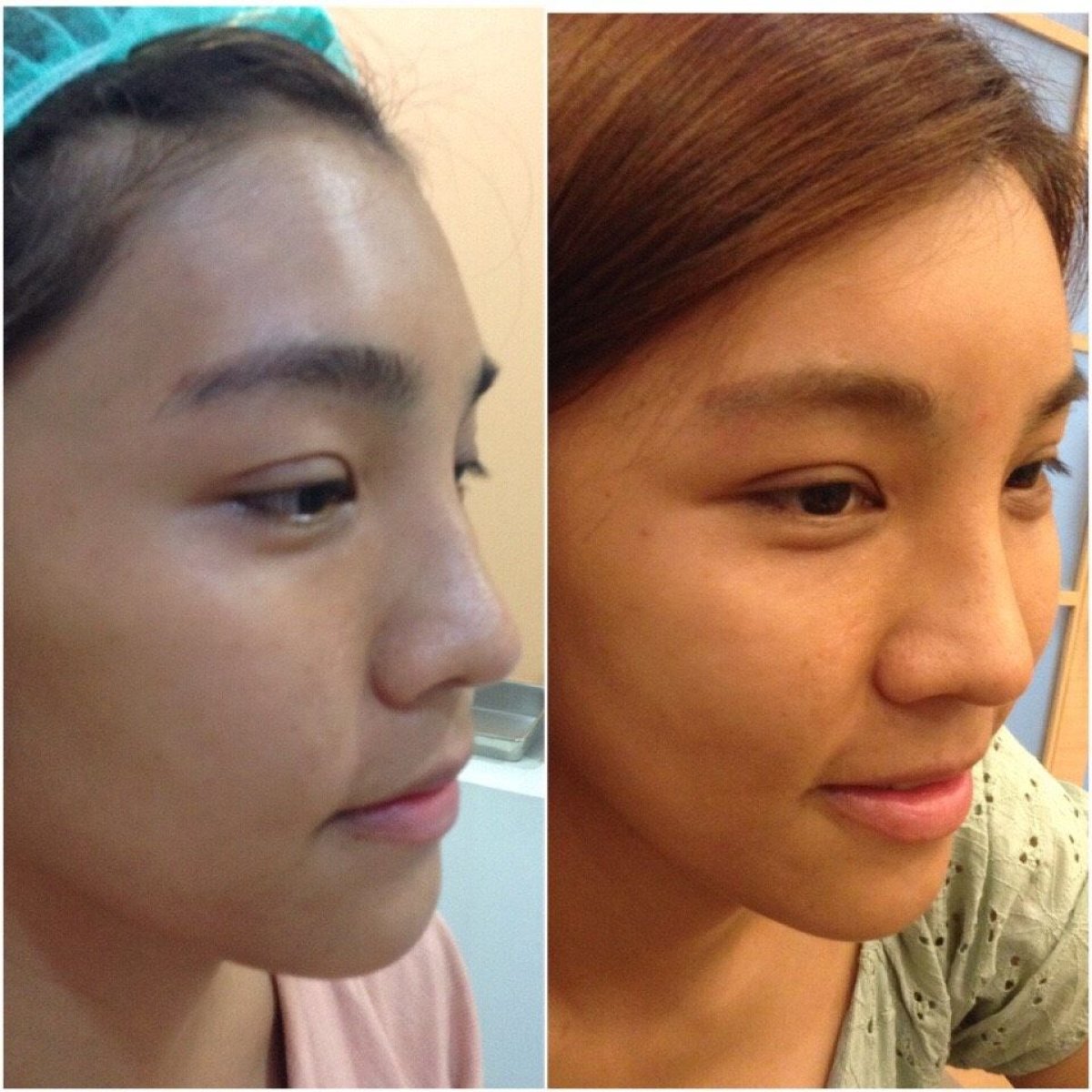 Résultats avant/après lipofilling visage à Asia Cosmetic Hospital, volume facial amélioré