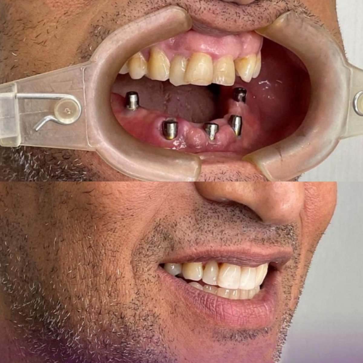 نتائج زراعة الأسنان قبل وبعد في Paulino Almonte Dental Team، ابتسامة مستعادة