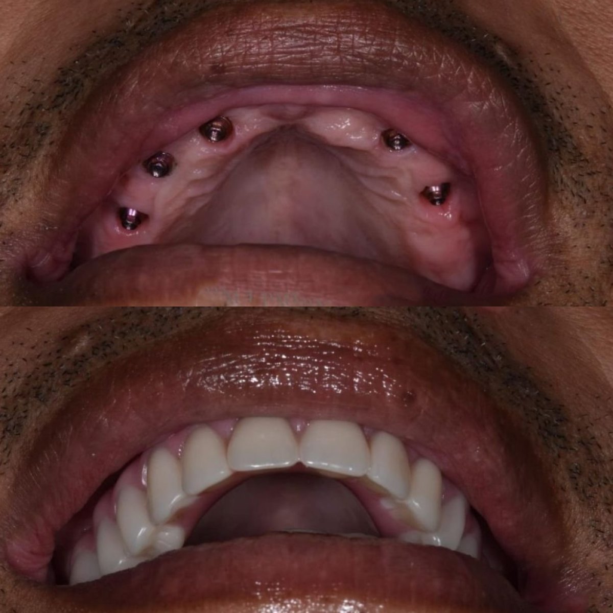 Before and after dental implant results at Paulino Almonte Dental Team, restored upper teeth