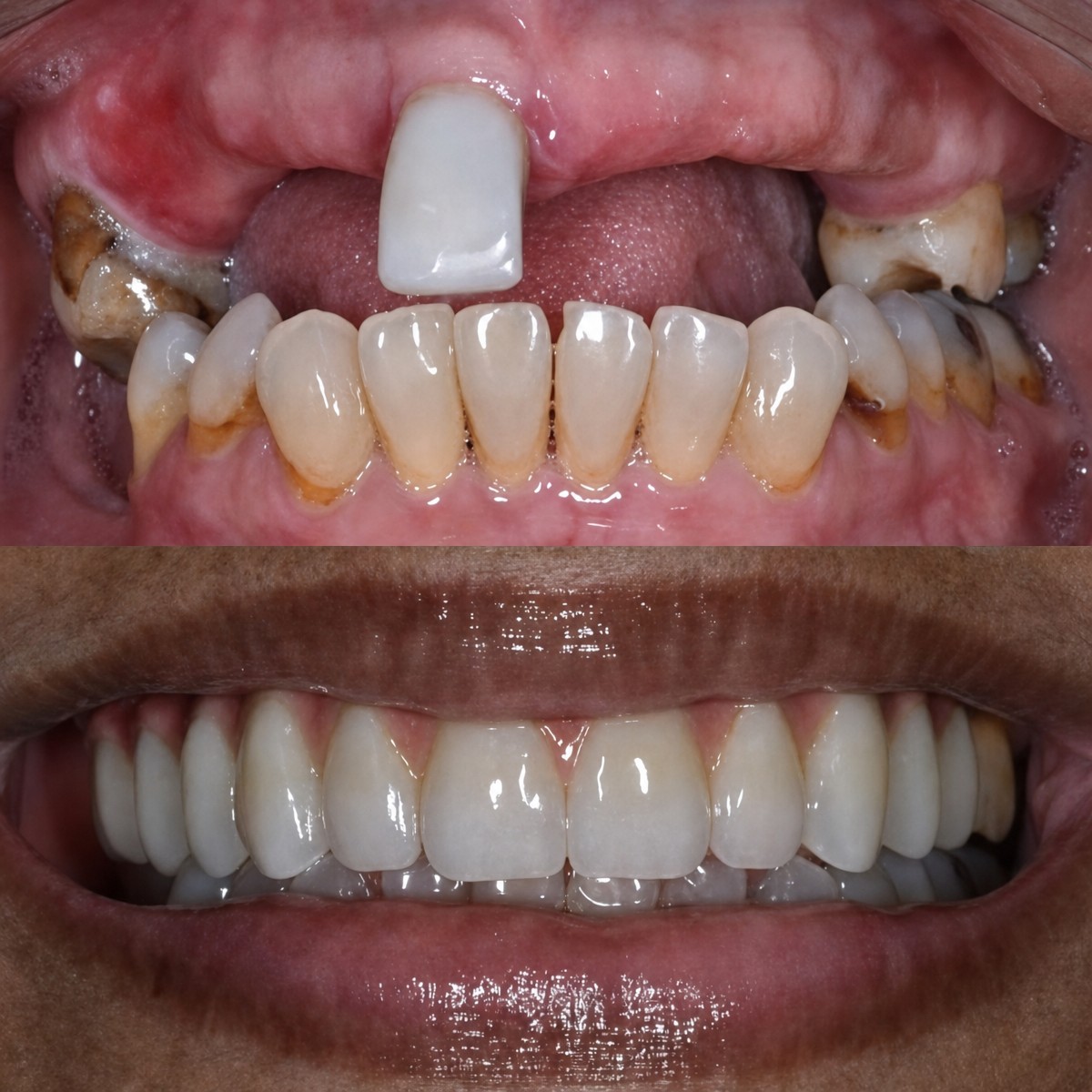 Результаты до и после имплантации зубов в Paulino Almonte Dental Team, восстановленная улыбка