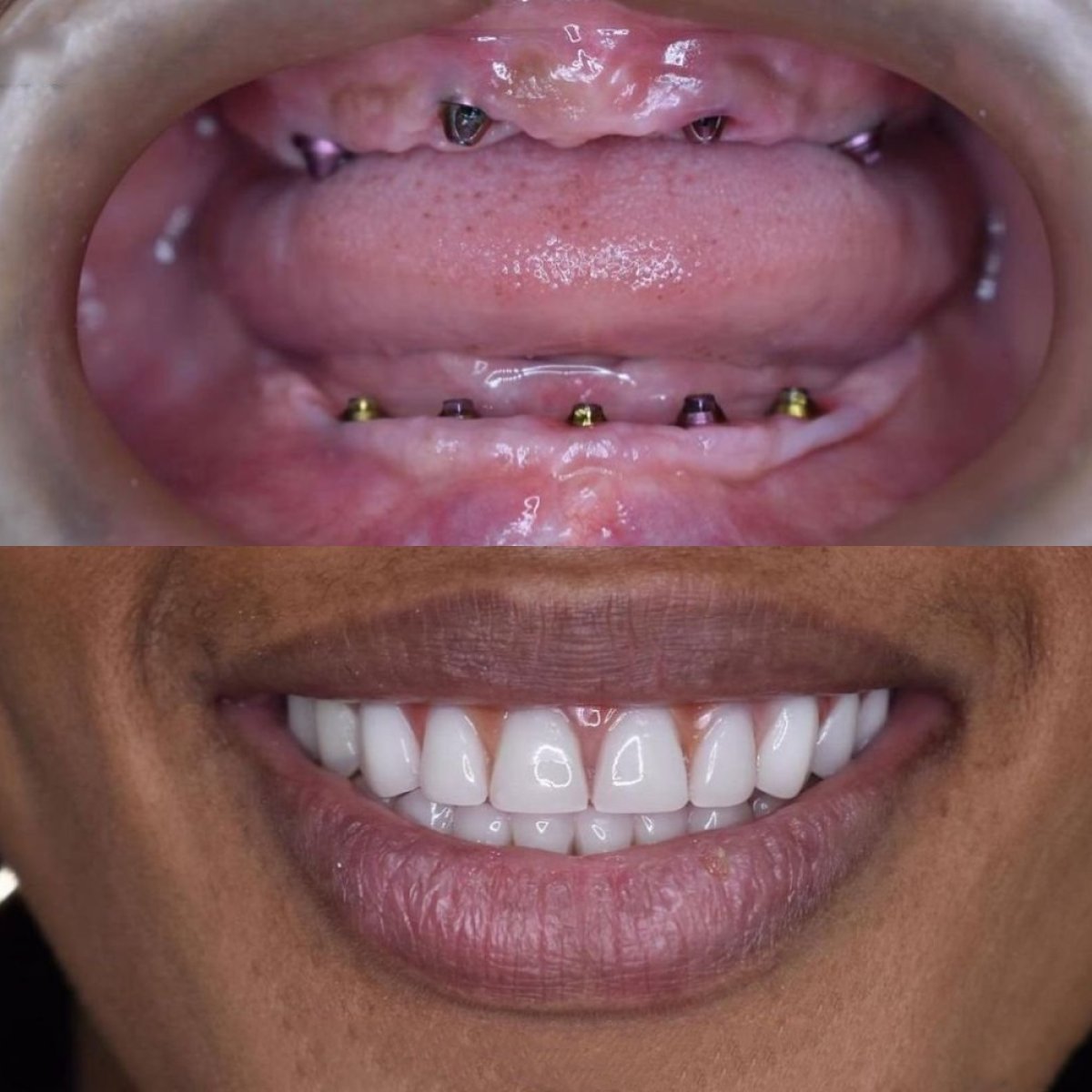 Vorher-nachher-Ergebnis All-on-4-Implantate bei Paulino Almonte Dental Team, Lächeln wiederhergestellt