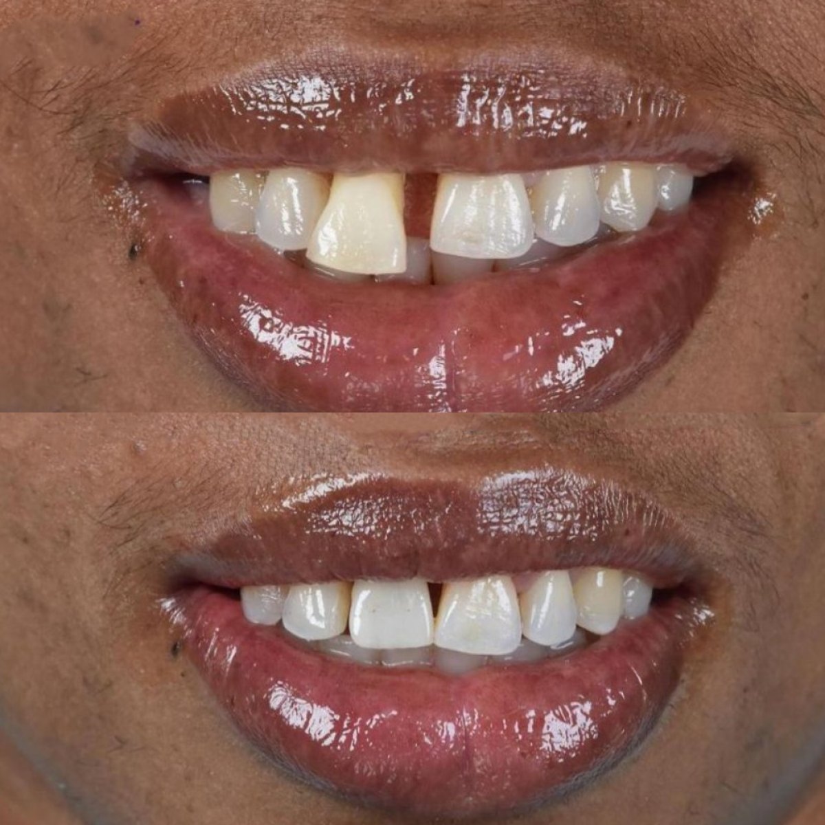 نتائج قبل وبعد زراعة الأسنان في Paulino Almonte Dental Team، تحسين الفجوة بالابتسامة