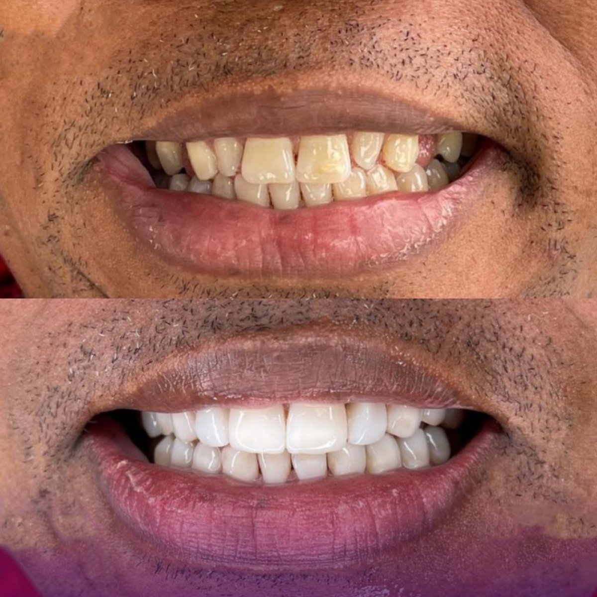 Vorher-nachher-Ergebnis Veneers bei Paulino Almonte Dental Team, sichtbare Smile-Transformation
