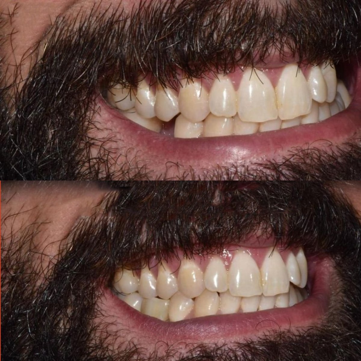 نتائج قبل وبعد زراعة الأسنان في Paulino Almonte Dental Team، ابتسامة محسنة