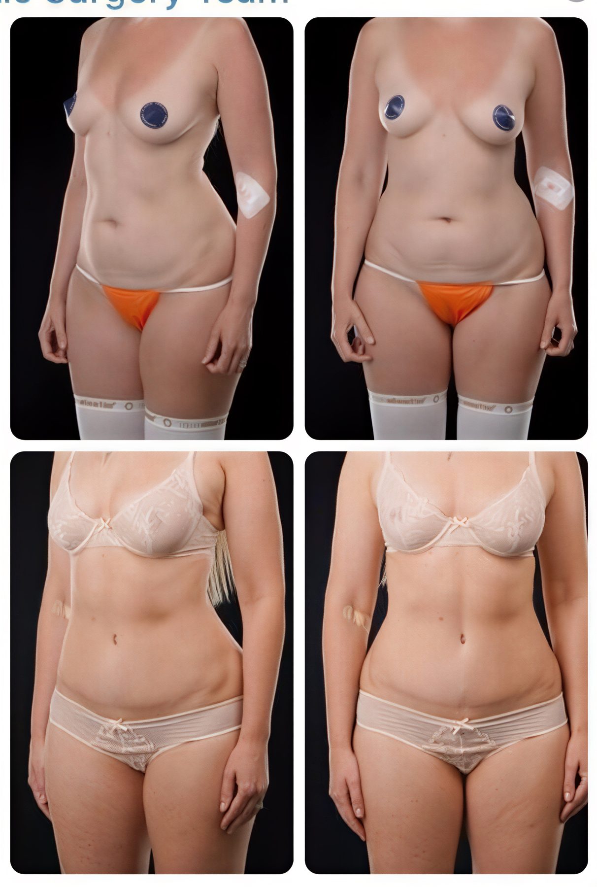 Resultados de abdominoplastia y liposucción antes y después en Yurchenko Plastic Surgery Team Kyiv