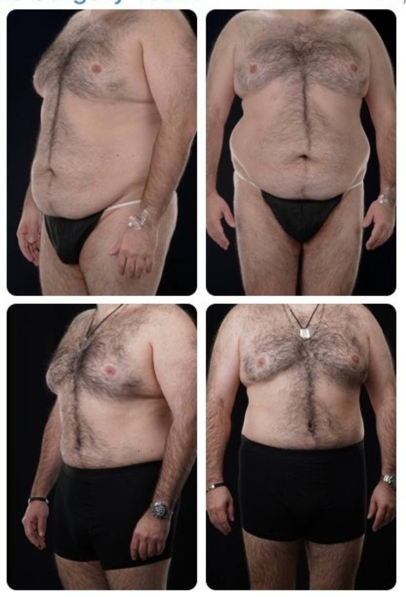 Before and after tummy tuck and liposuction results at Yurchenko Plastic Surgery Team Kyiv