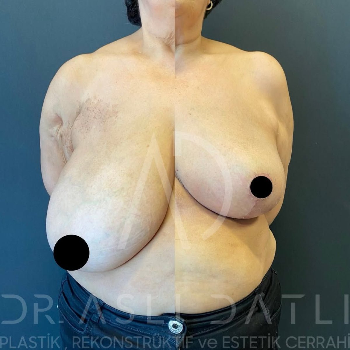 Résultats avant/après réduction mammaire à Liv Hospital Ulus, amélioration visible