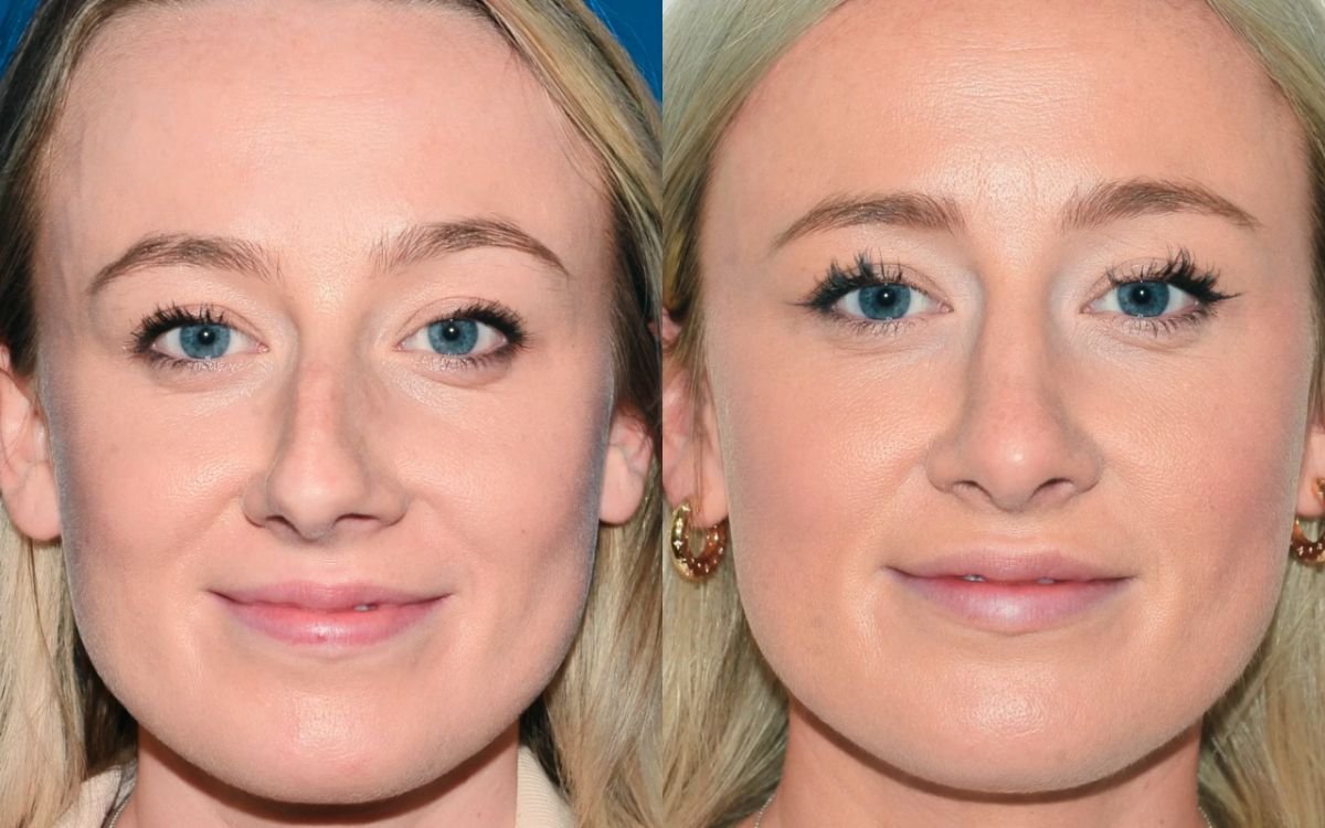 Before and after rhinoplasty results at Veselibu Clinic, nose reshaping with natural look