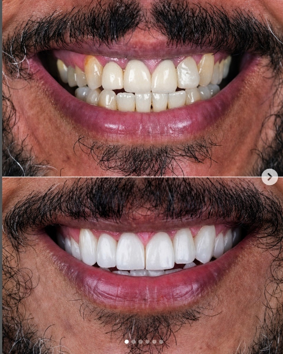 نتائج قبل وبعد تركيب تاج فوري في Odontoliuzzi Dentistry and Health، ابتسامة محسنة