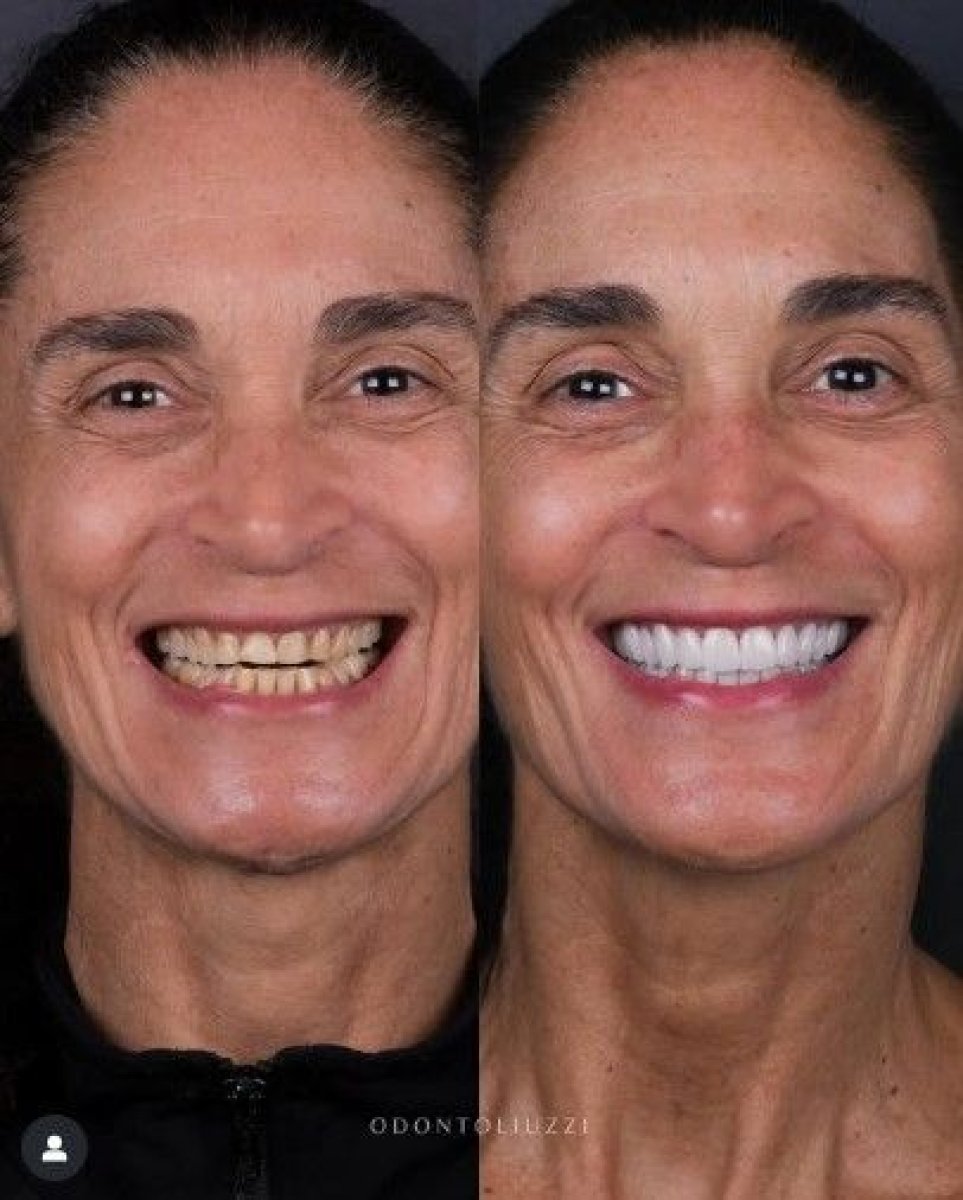 نتائج قبل وبعد تركيب تيجان فورية في Odontoliuzzi Dentistry and Health، ترميم الابتسامة