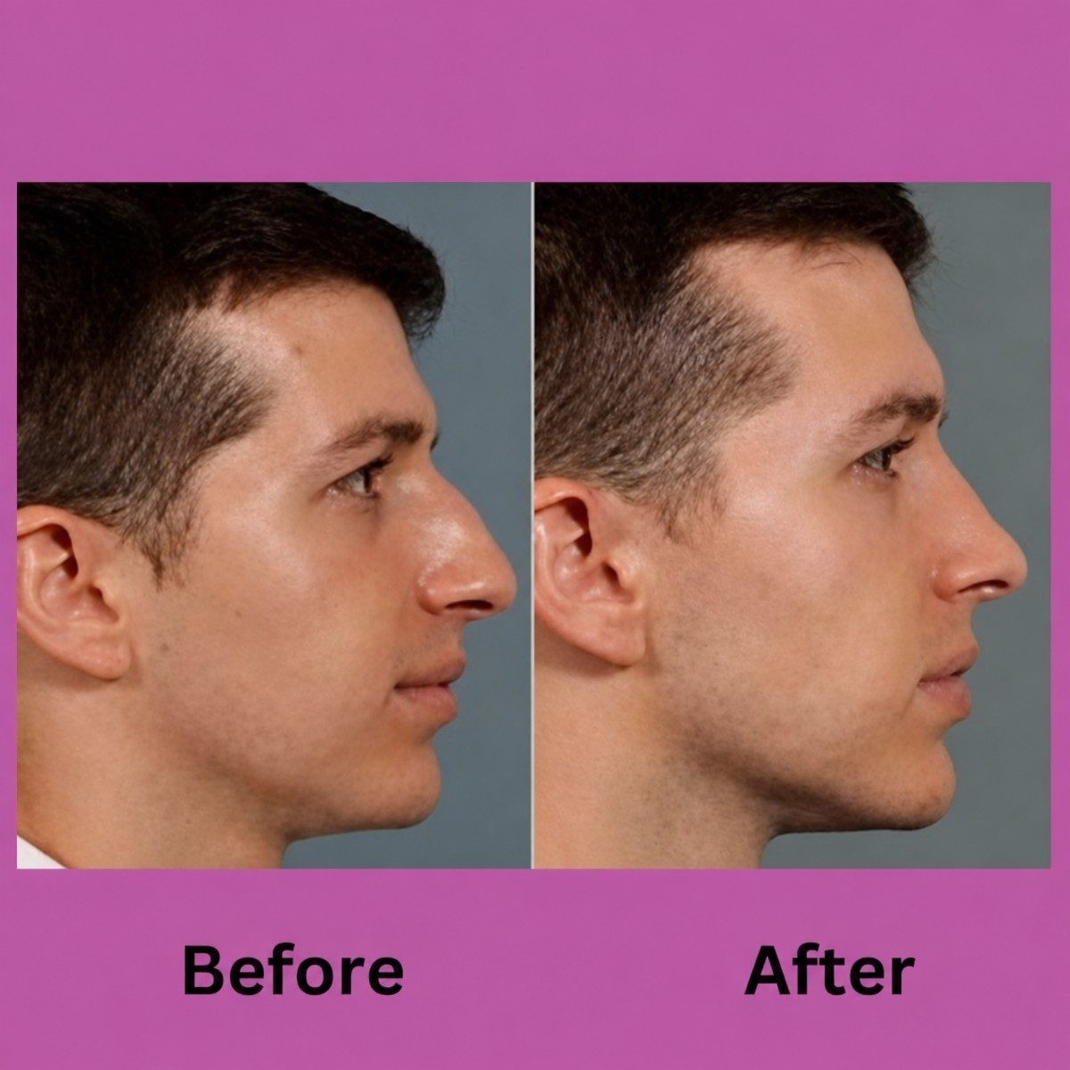 Resultados antes y después de rinoplastia cerrada en ID Clinic Bangkok, perfil nasal mejorado