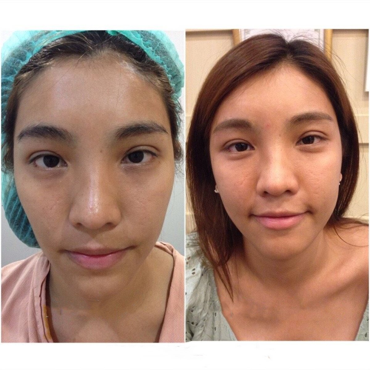 Résultats avant/après lipofilling visage à Asia Cosmetic Hospital, volume amélioré