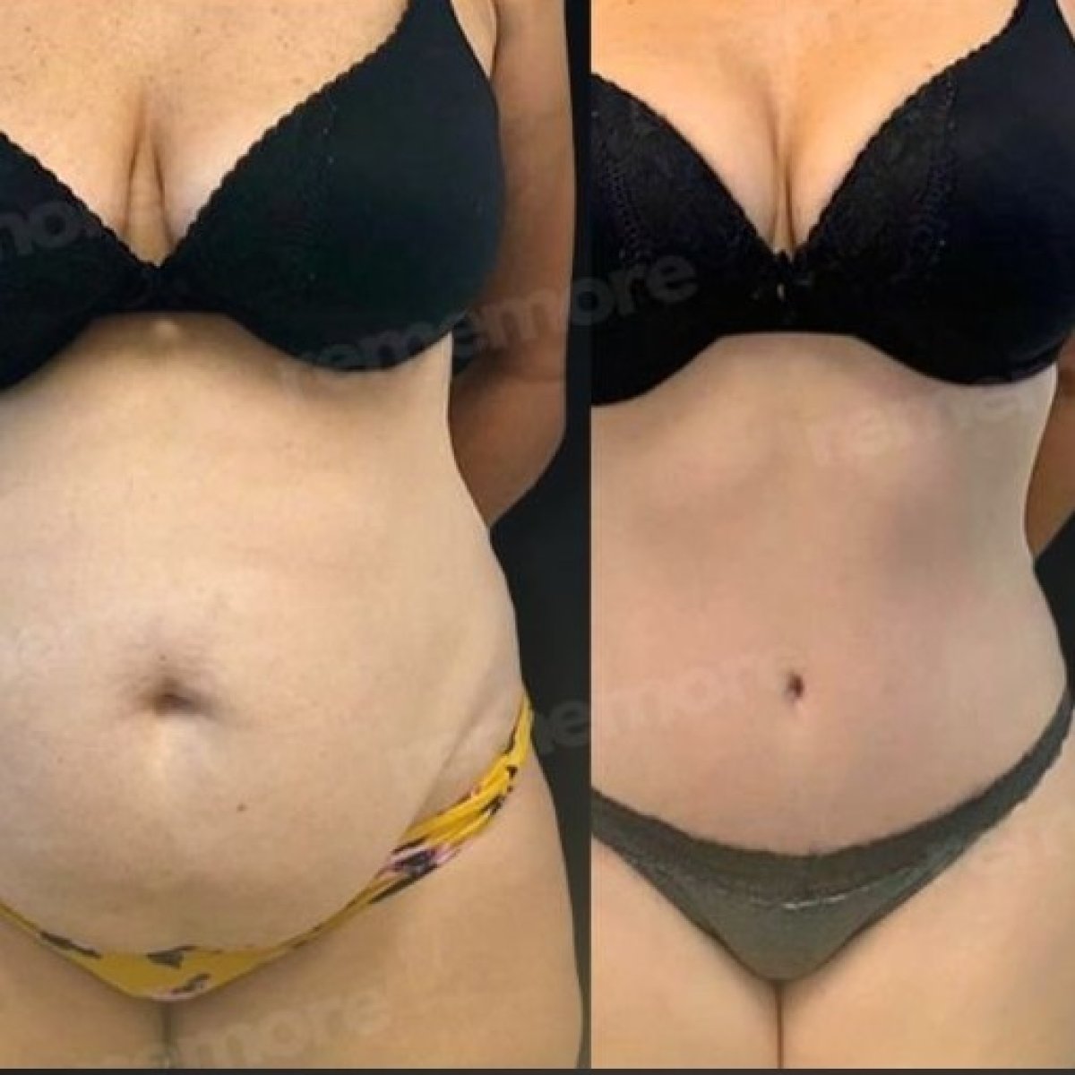 Before and after tummy tuck results at Memorial Ankara Hospital, visible abdominal contouring