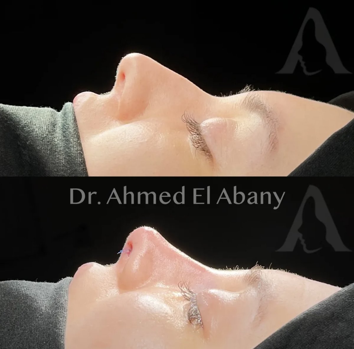 نتائج عملية تجميل الأنف قبل وبعد في PyraMedicine، إعادة تشكيل الأنف بمظهر طبيعي