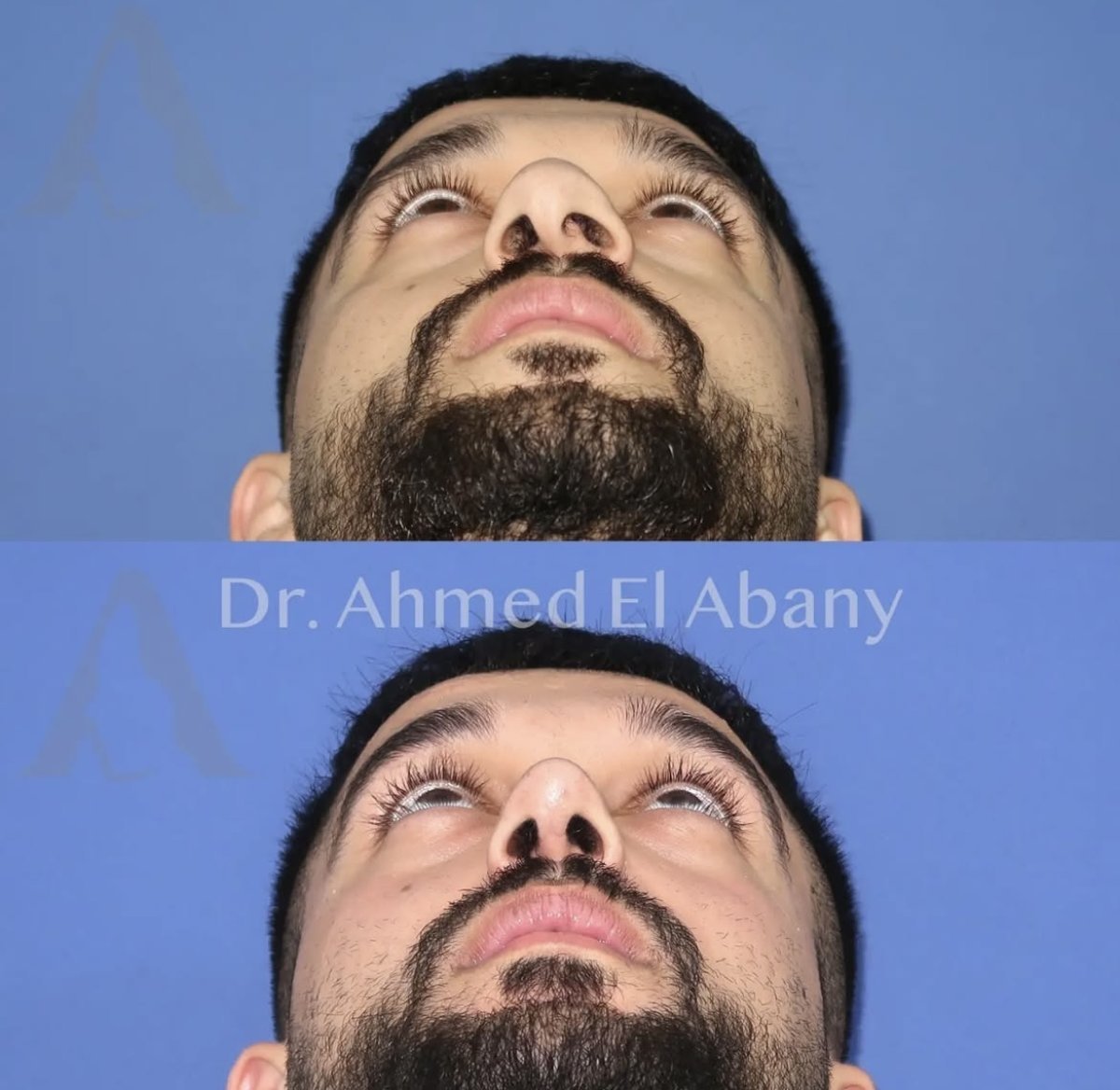 Résultats avant et après rhinoplastie chez PyraMedicine, symétrie et forme du nez améliorées