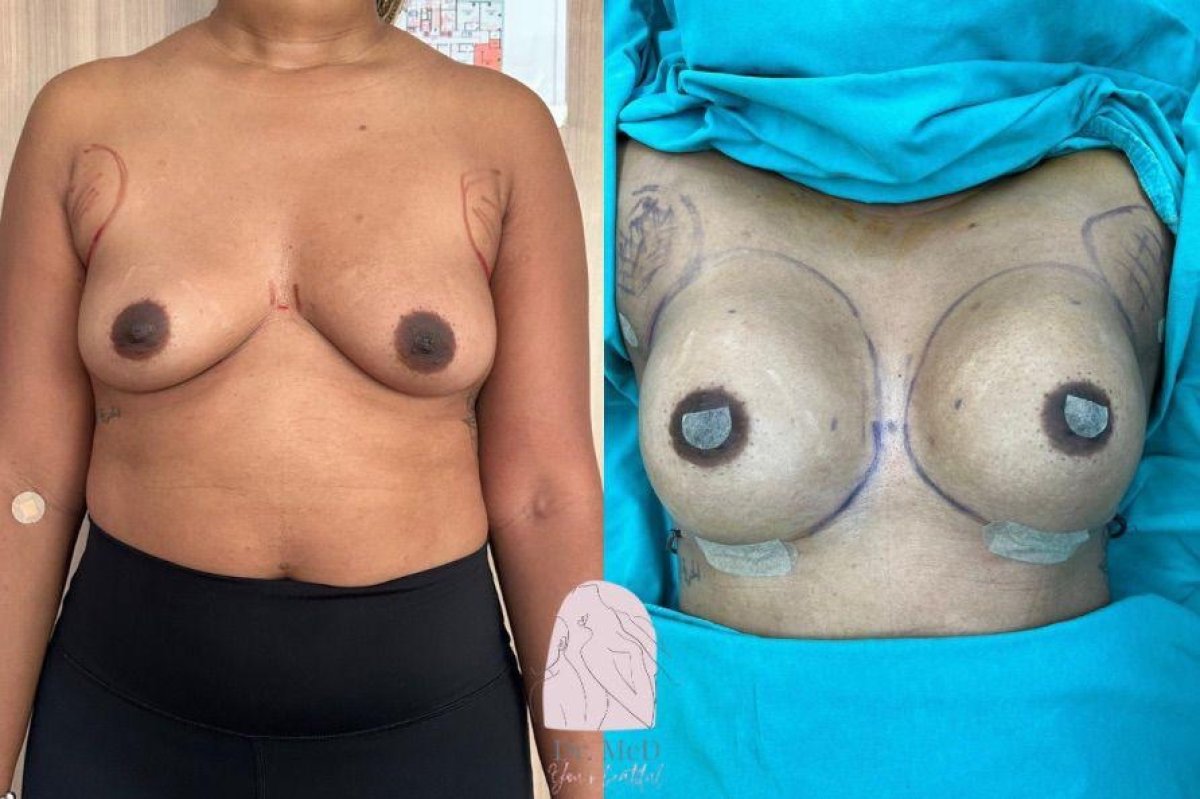 نتائج قبل وبعد تكبير الثدي في عيادة Dr. MED، تحسين شكل الثدي