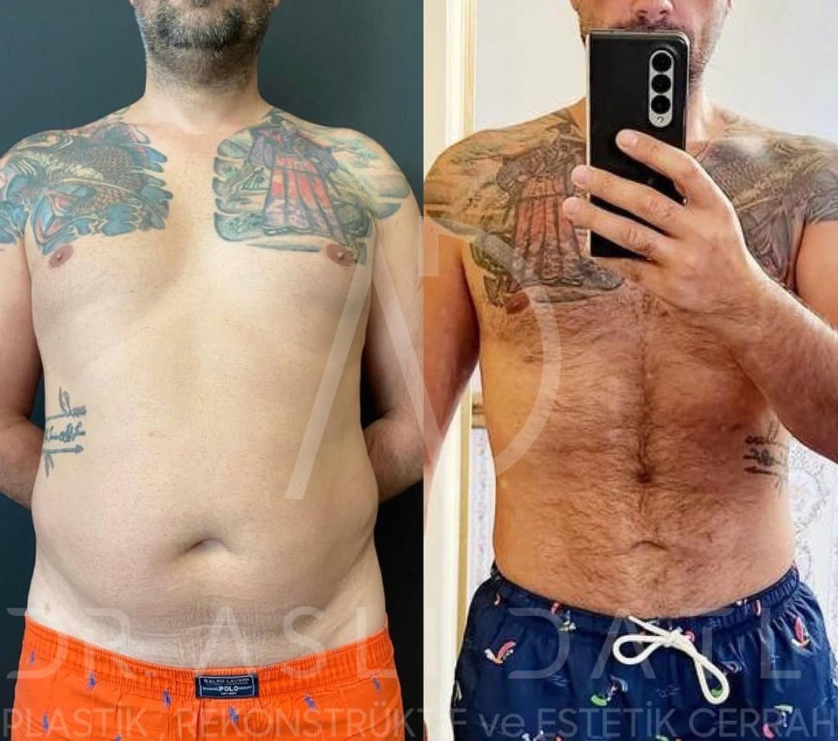 Full body lift before and after results at Liv Hospital Ulus, visible body contour improvement