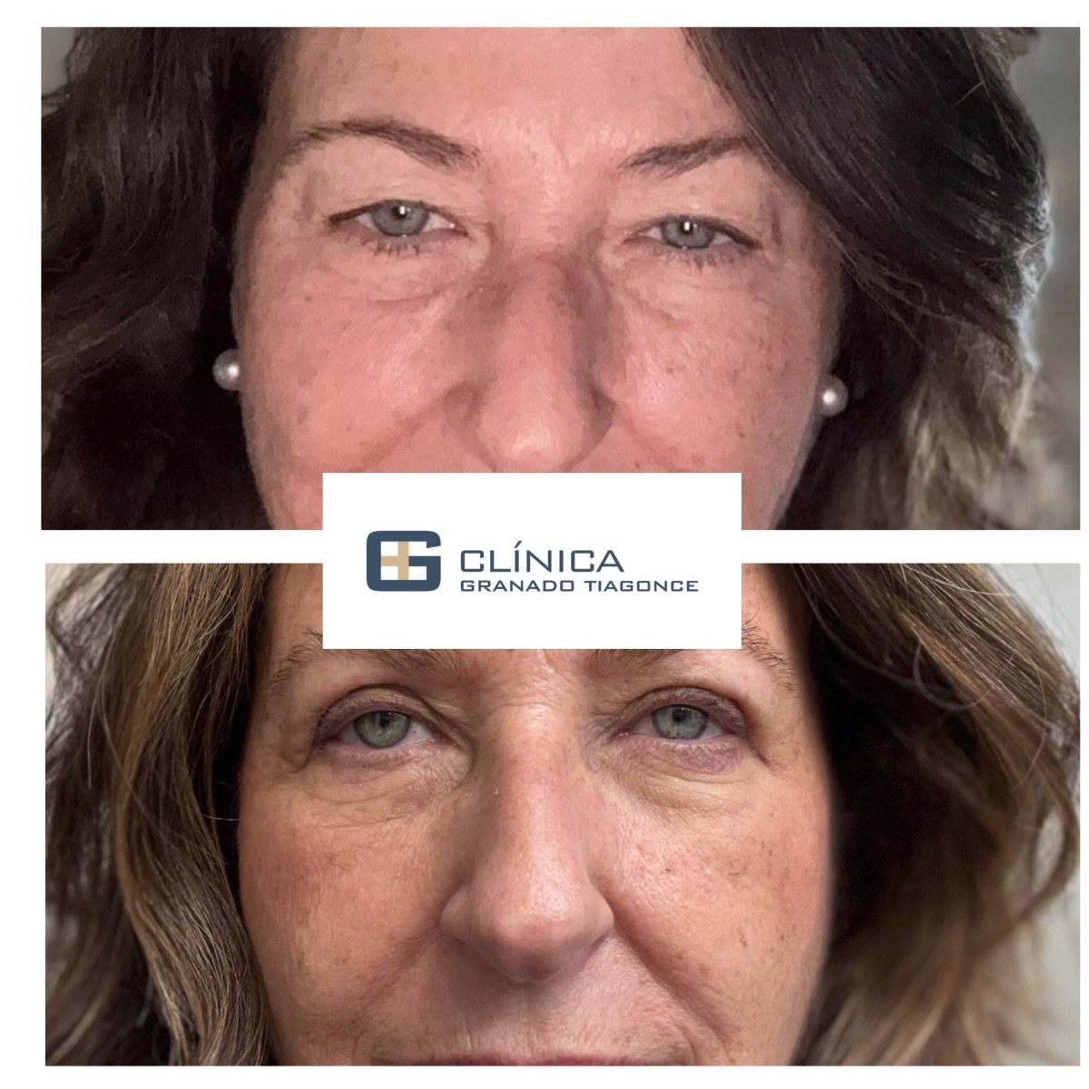 نتائج رأب الجفن قبل وبعد في Clinica Granado Tiagonce، تصحيح الجفون