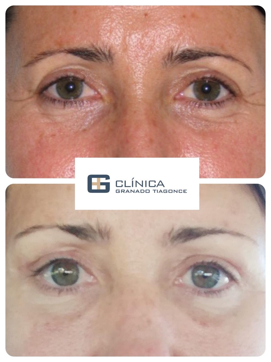 نتائج رأب الجفن قبل وبعد في Clinica Granado Tiagonce، تصحيح الجفون