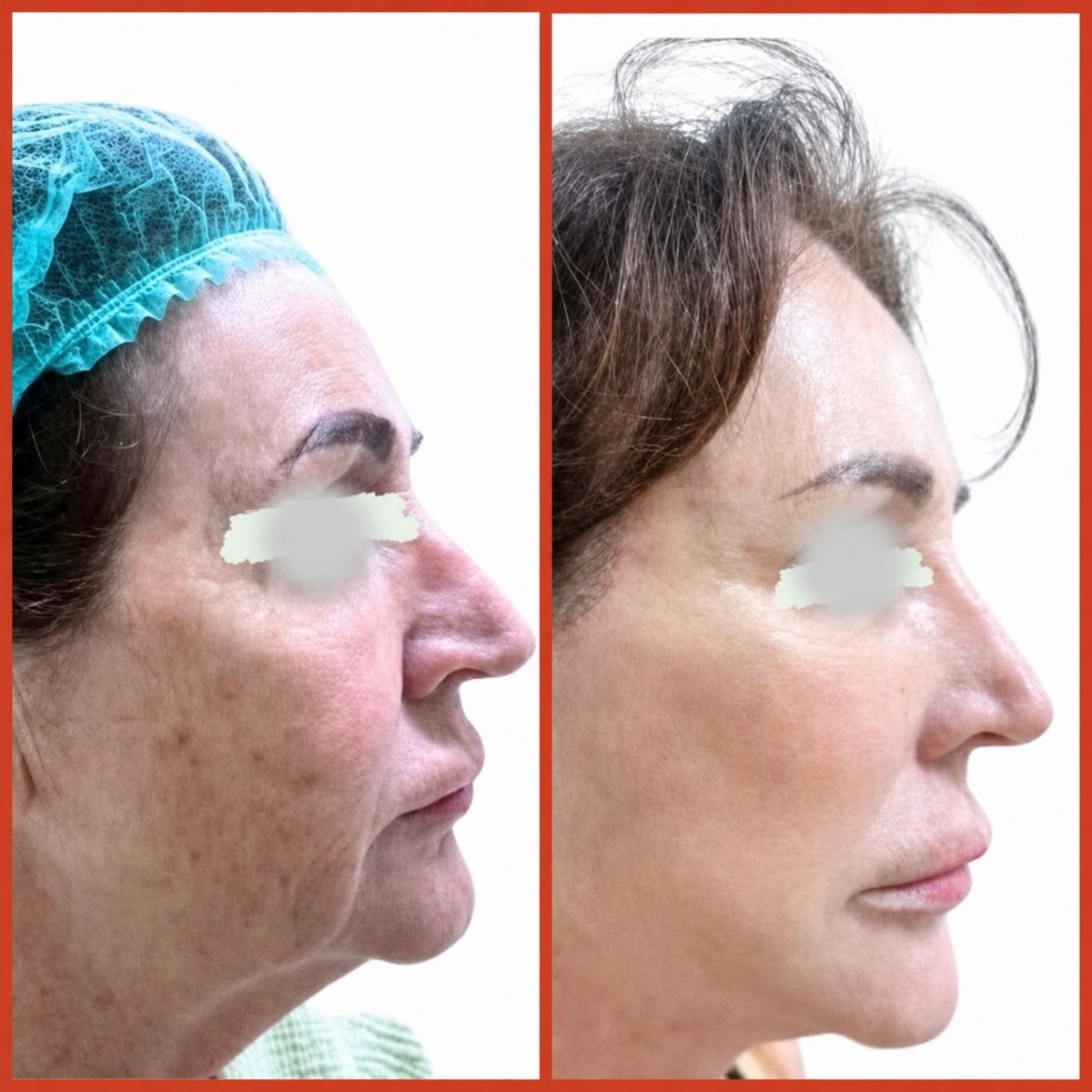Before and after facelift results at DGB Clinic – visible facial rejuvenation and tightening