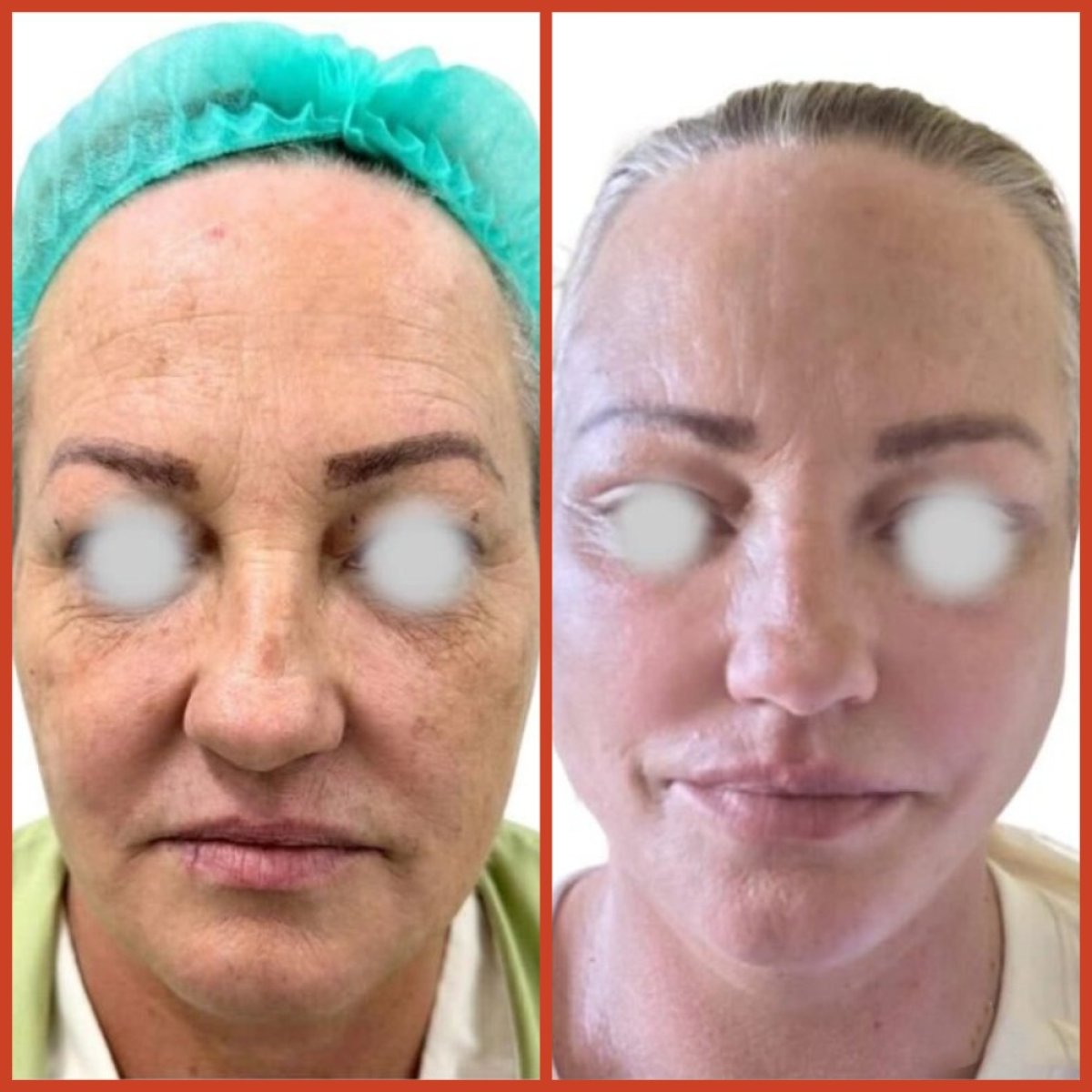 Resultados de lifting facial antes y después en DGB Clinic – rejuvenecimiento visible