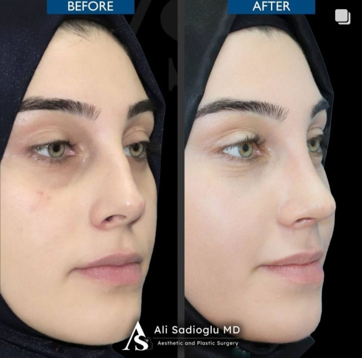 Resultados de rinoplastia antes y después en Dr. Safa Manav Clinic, remodelación nasal femenina