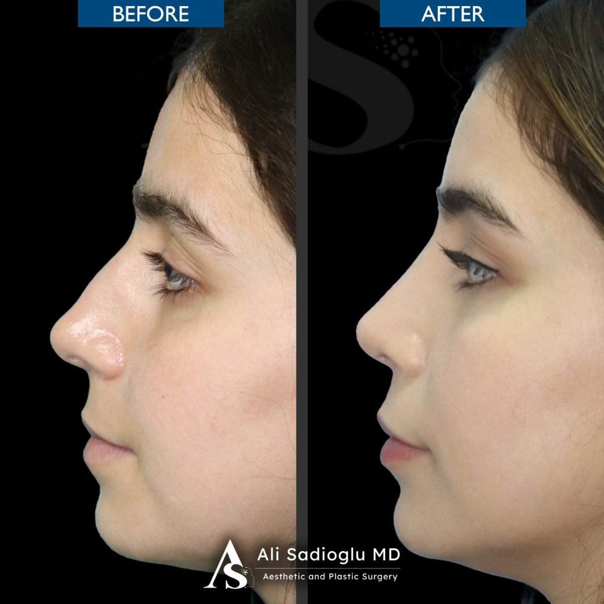 Resultados de rinoplastia antes y después en Dr. Safa Manav Clinic, remodelación natural de nariz