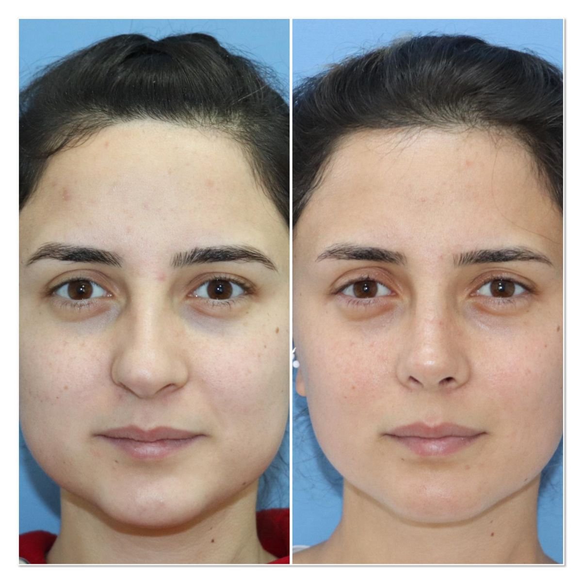 Resultados de rinoplastia antes y después en Dr. Safa Manav Clinic, mejora de la nariz