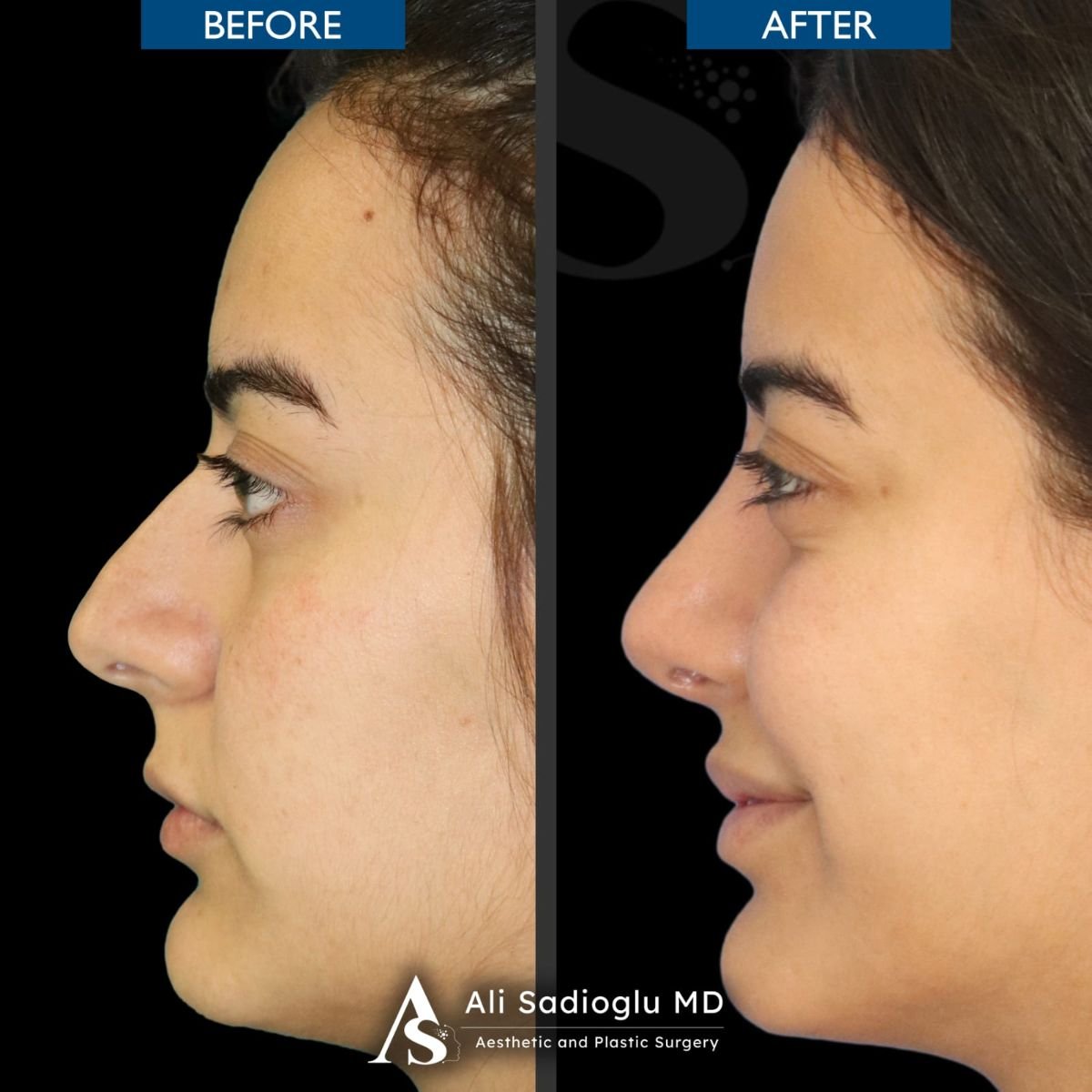 Before and after rhinoplasty results at Dr. Safa Manav Clinic, improved nose profile