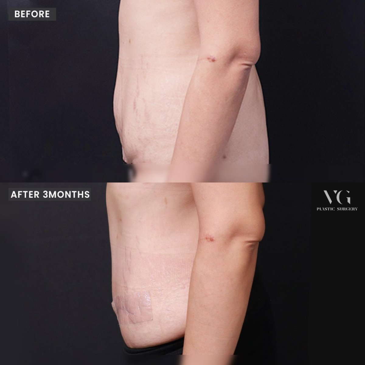 Before and after tummy tuck results at VG Plastic Surgery, flatter abdomen after 3 months