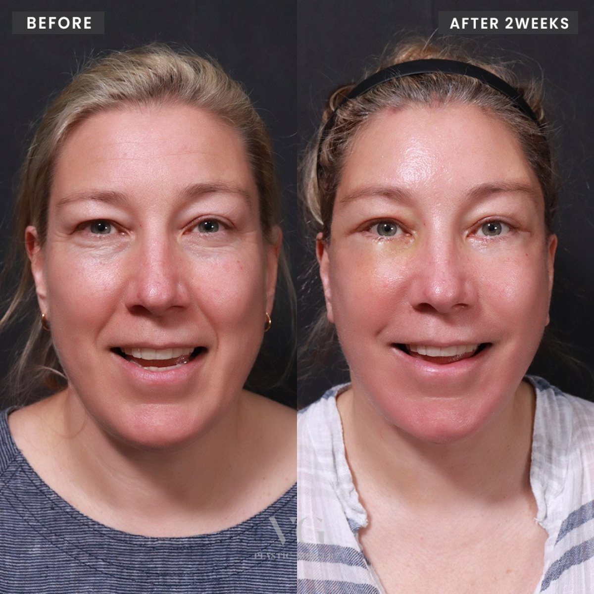 Facelift before and after results at VG Plastic Surgery, visible facial rejuvenation after 2 weeks