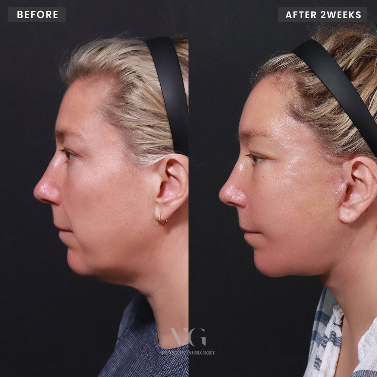 Resultados de lifting facial antes y después en VG Plastic Surgery, mejora de mandíbula y cuello