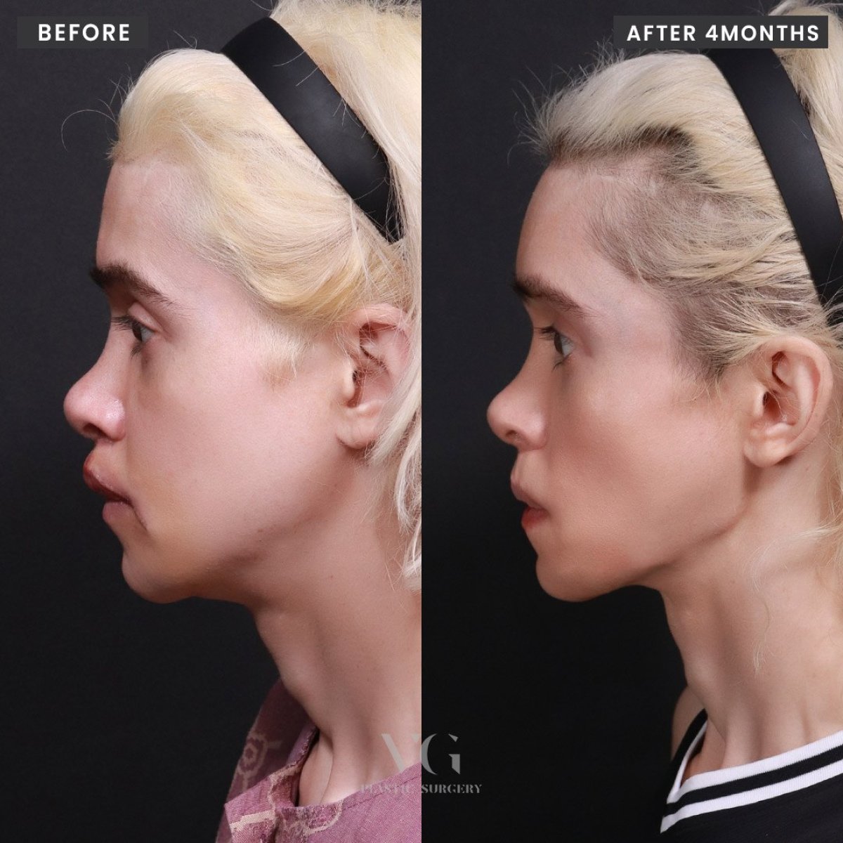 نتائج تكبير الجبهة بالزرع قبل وبعد في VG Plastic Surgery بعد 4 أشهر