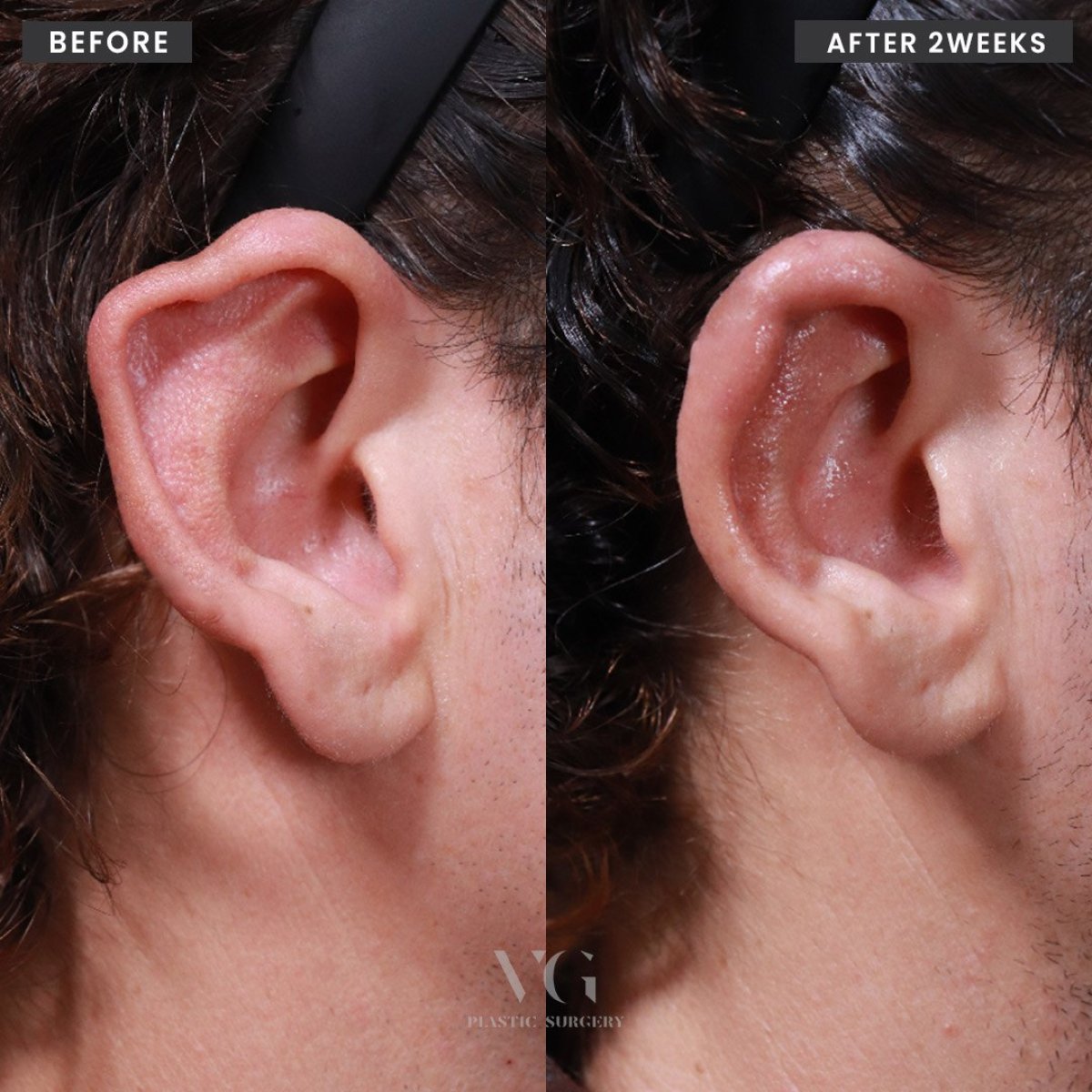 Resultados de otoplastia antes y después en VG Plastic Surgery, mejora tras 2 semanas