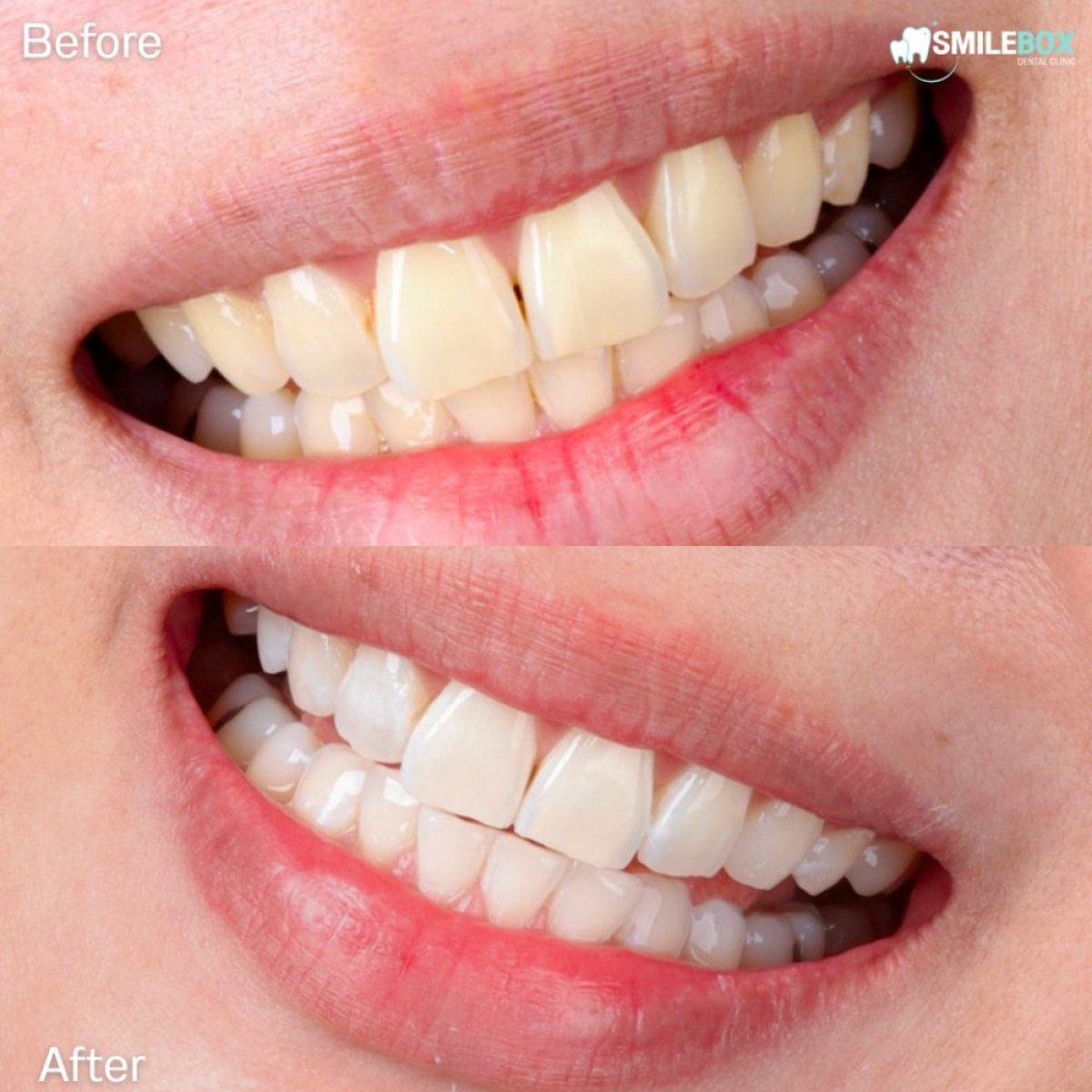 نتائج قبل وبعد تبييض الأسنان بالليزر في SmileBox Dental Clinic - Thonglor