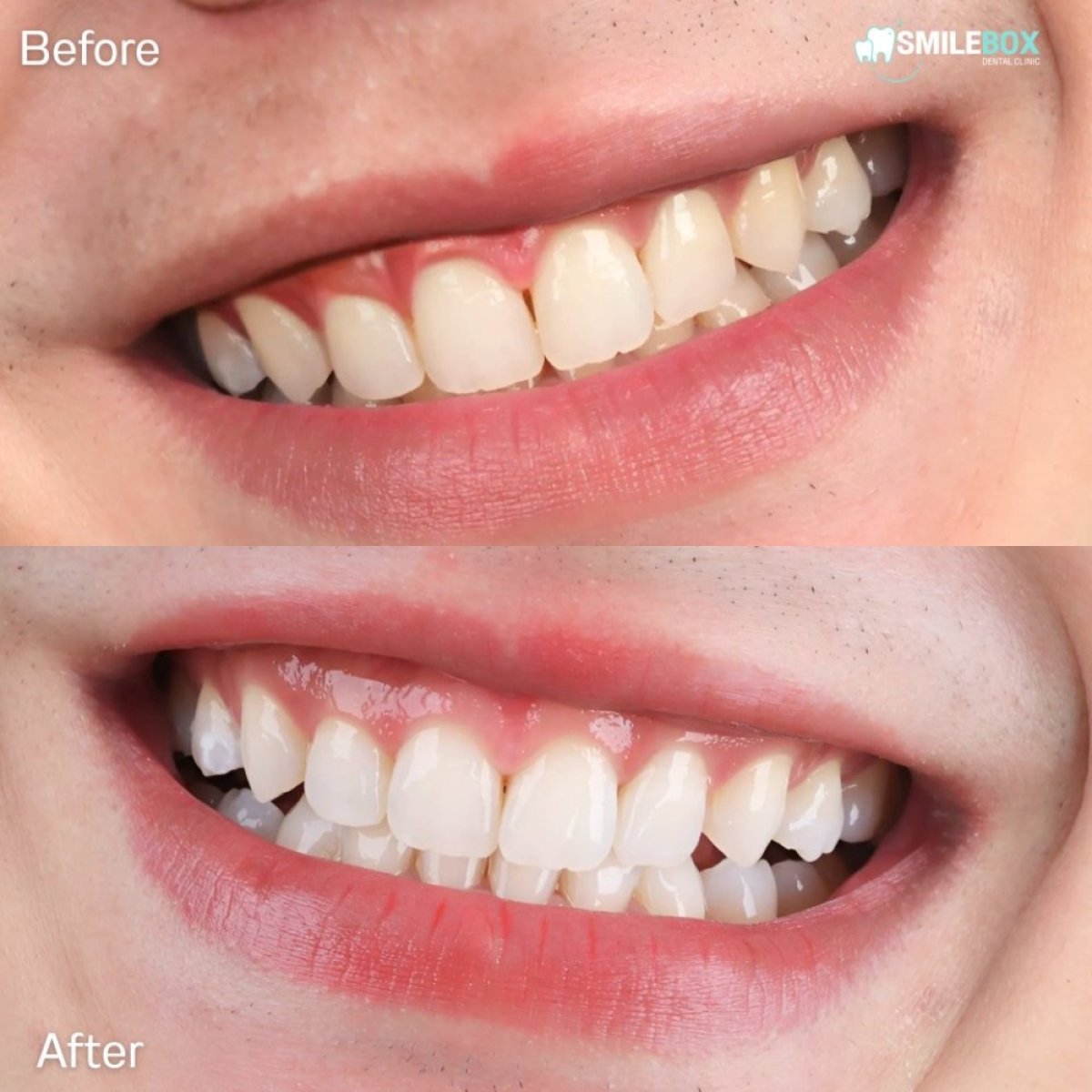 Vorher-nachher-Ergebnis der Laserzahnaufhellung bei SmileBox Dental Clinic - Thonglor, Sukhumvit