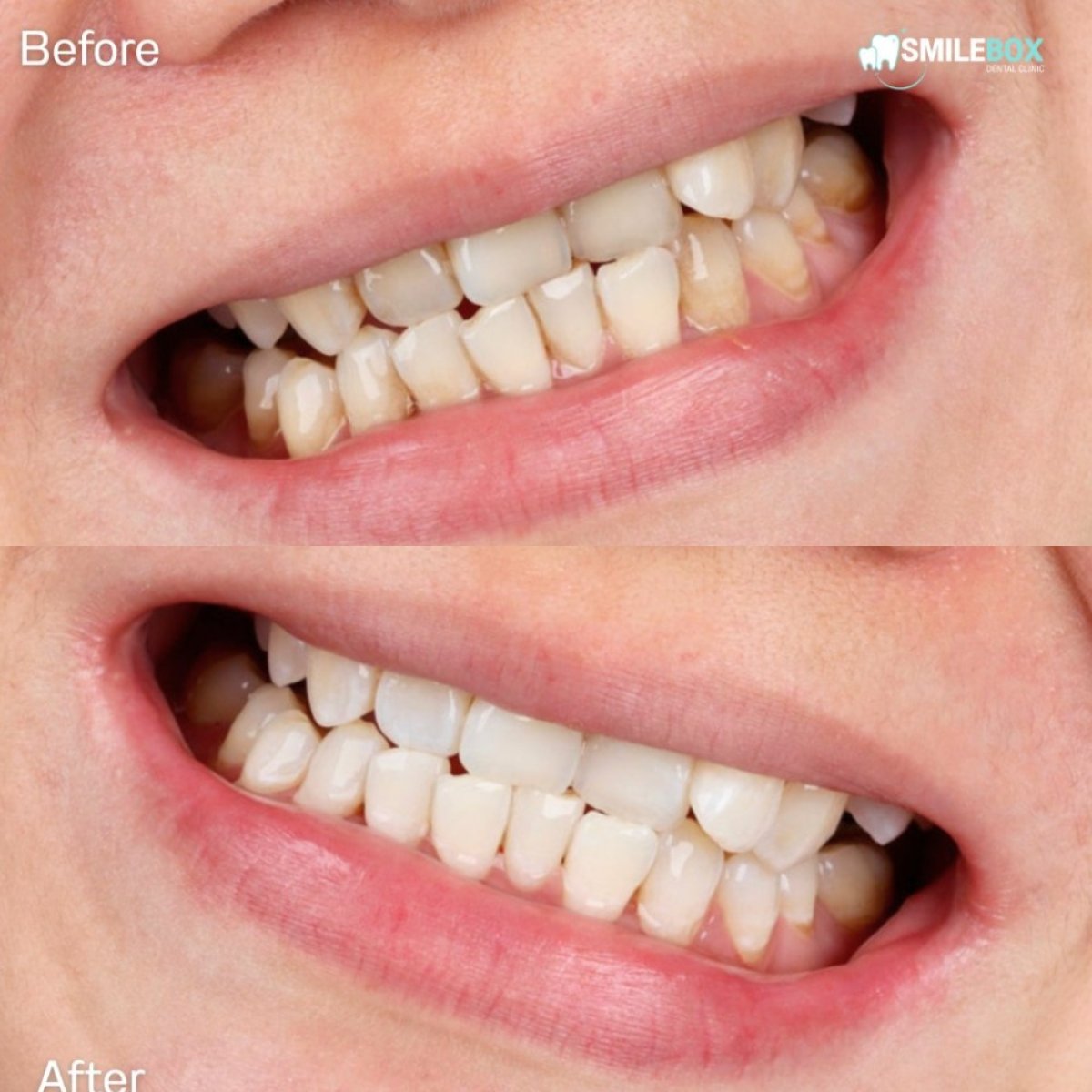 Resultado antes y después de blanqueamiento dental láser en SmileBox Dental Clinic - Thonglor