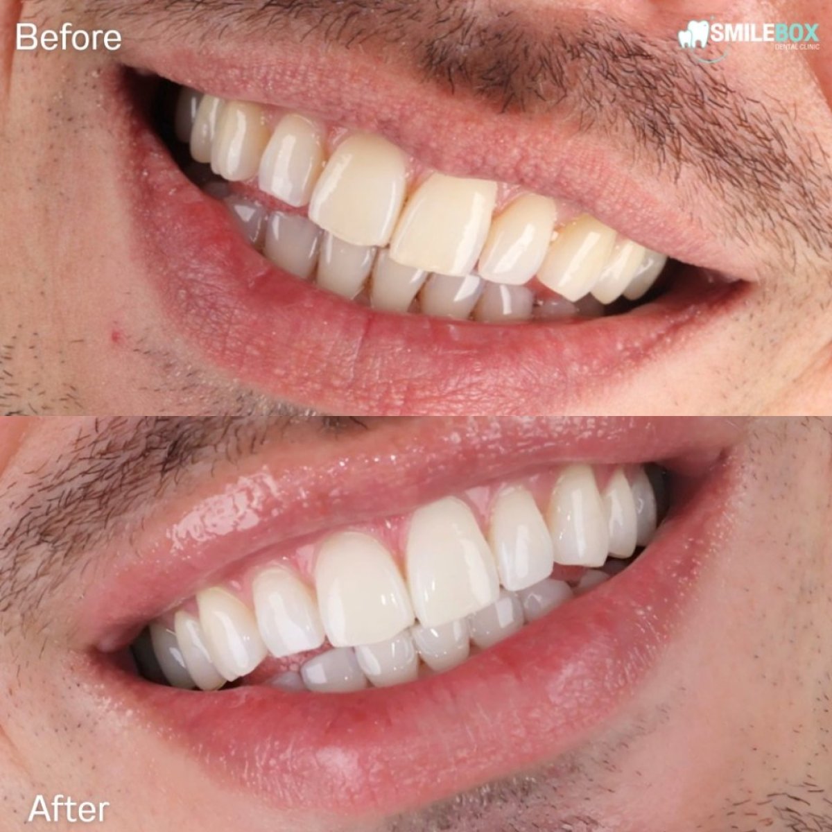 Resultados de blanqueamiento dental láser antes y después en SmileBox Dental Clinic - Thonglor, Sukhumvit